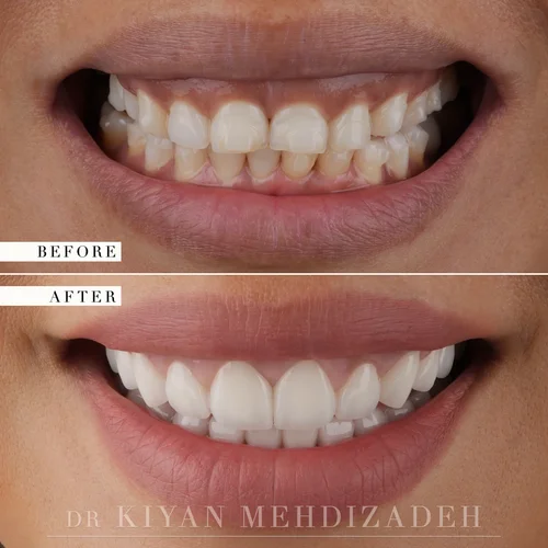 Gum lift and porcelain veneers before and after &mdash; Case Study 01 &mdash; Dr. Kiyan Mehdizadeh