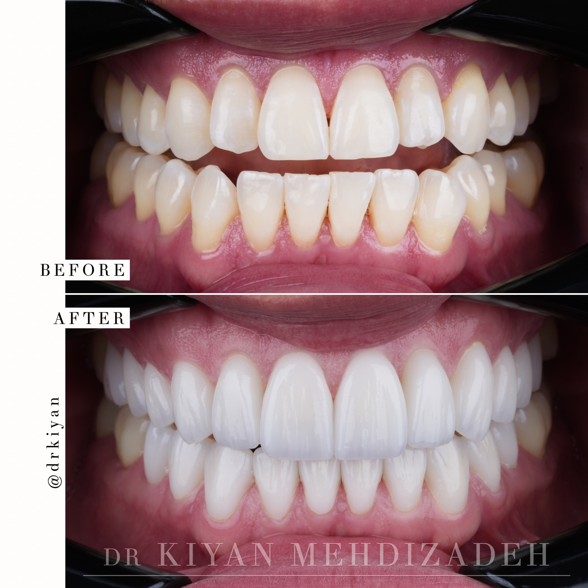After 22 porcelain veneers showing bright masculine smile with high surface texture