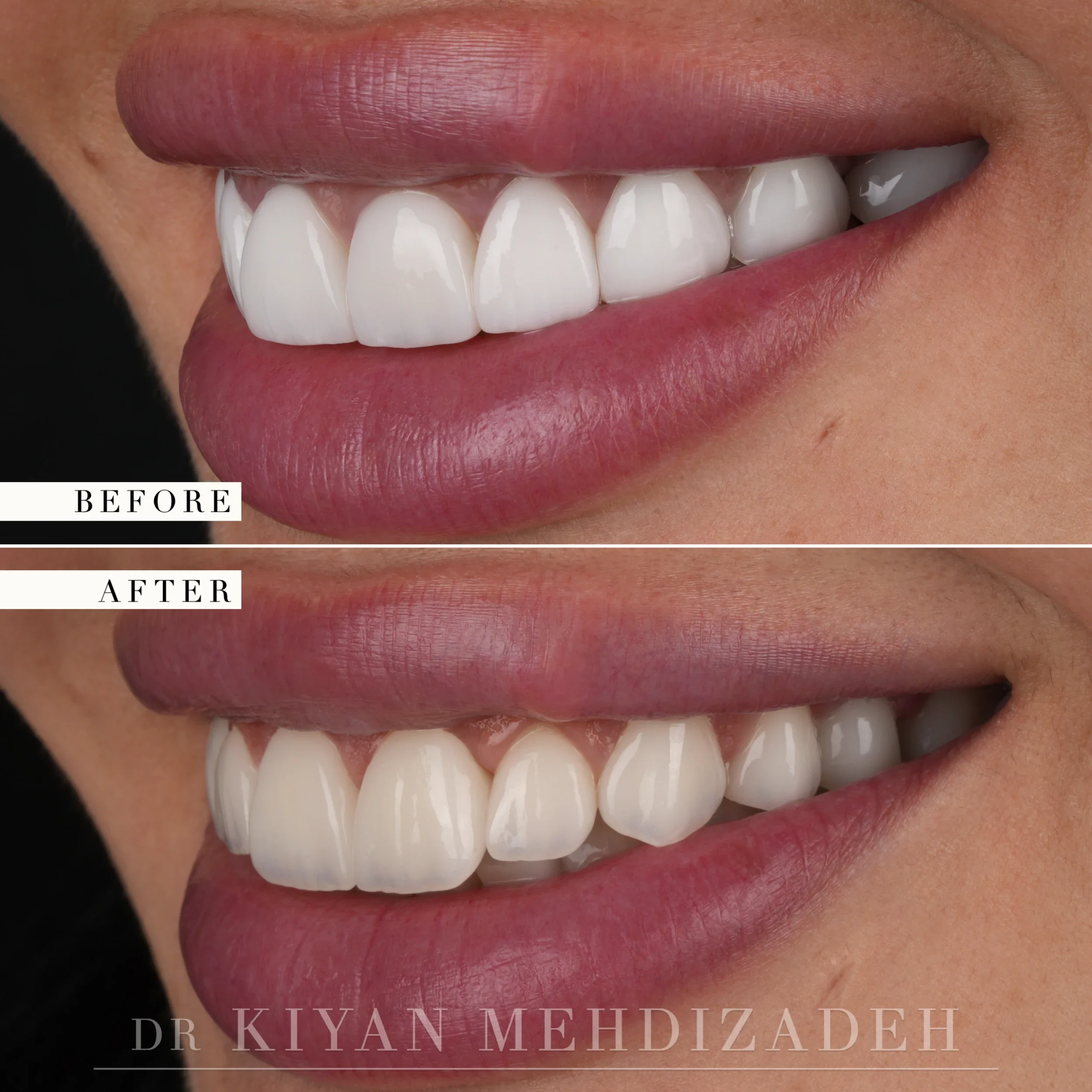 Before and after smile redesign - lateral smile angle from the left
