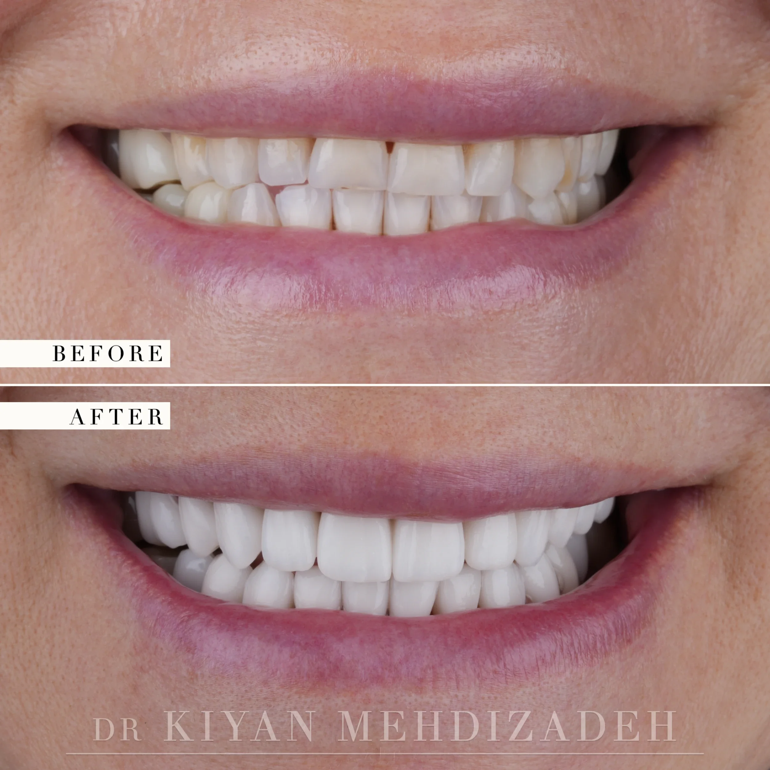 Before and after: worn, uneven incisal edges in a yellowed shade, restored to even length and a brighter shade across twenty-two units, Beverly Hills