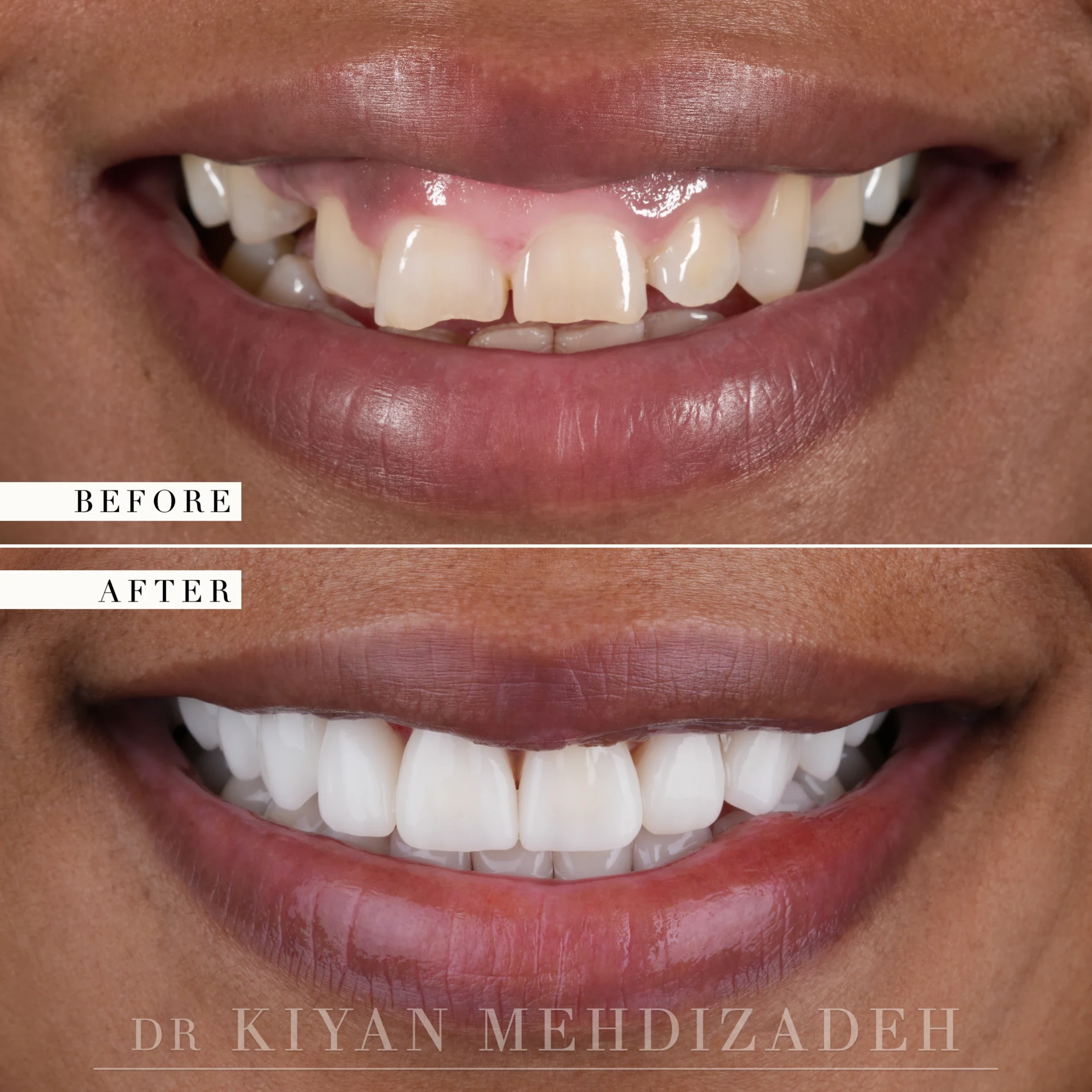 Before and after: an impacted canine, an uneven gum line and chipped teeth restored with an implant, a gum lift and nineteen veneers, Beverly Hills