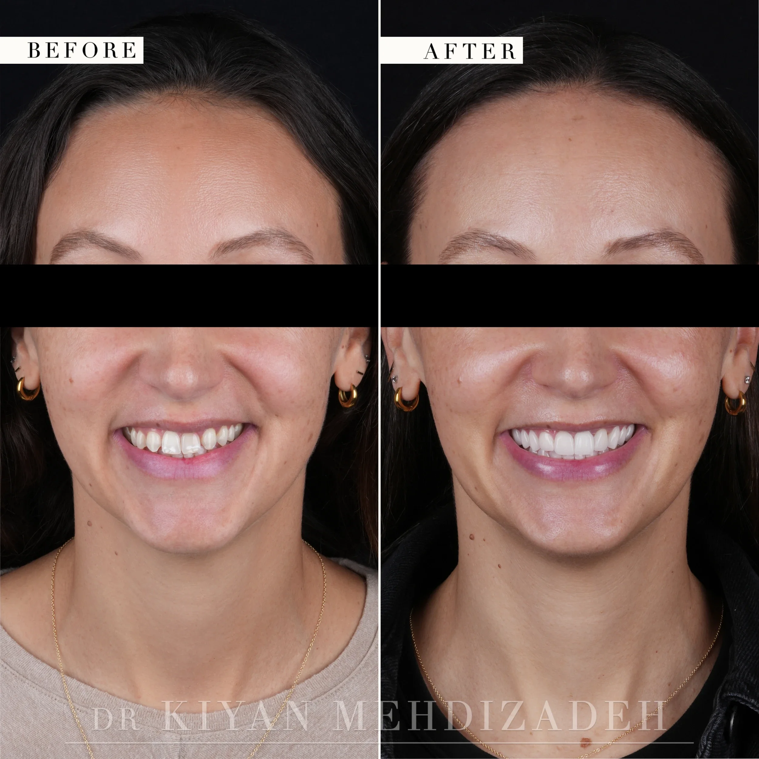 Full-face portraits before and after treatment, showing the restored smile in the context of the whole face