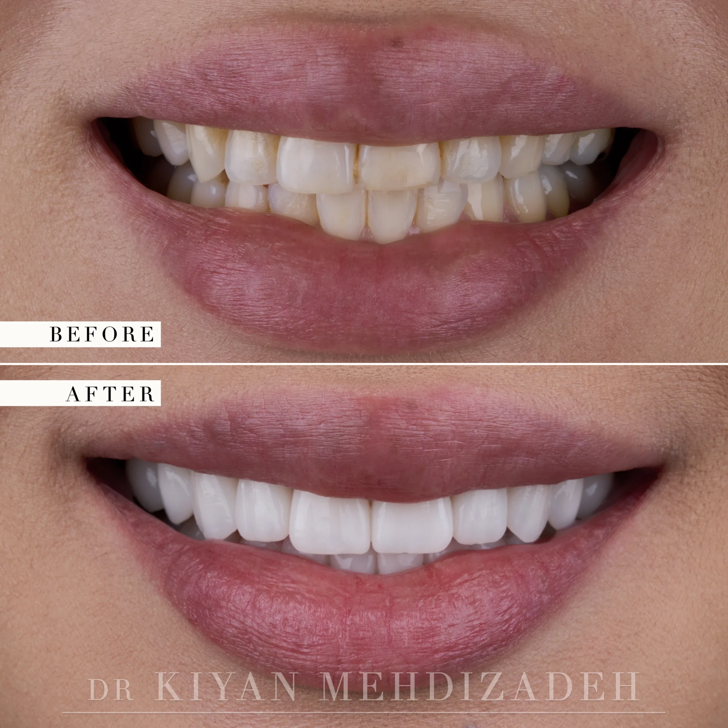 Before and after: crowded, darkened and rotated upper teeth restored to a symmetrical bright smile with twenty-one restorations, Beverly Hills