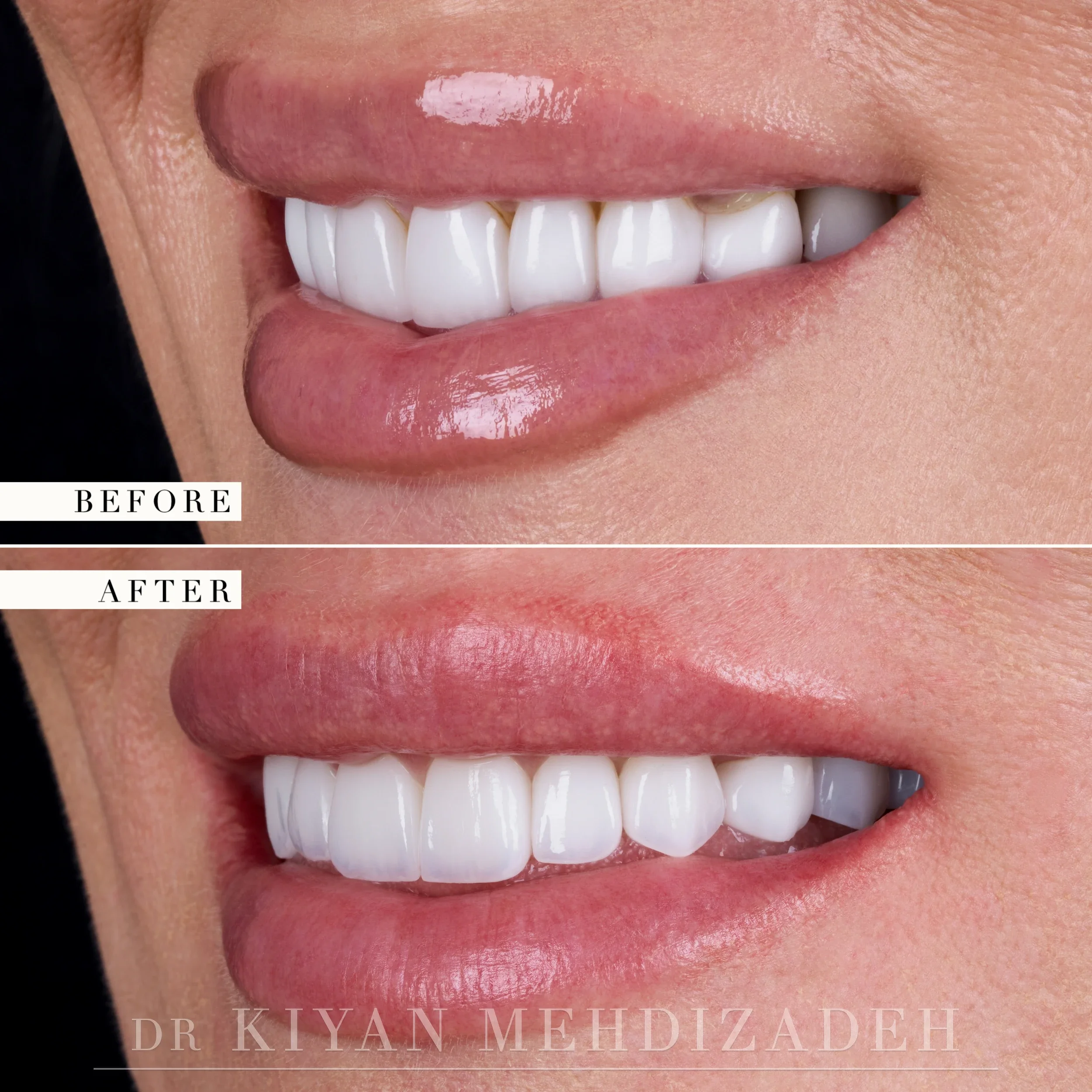 Before and after porcelain veneers and implant crowns - close-up of the smile from the left side, Beverly Hills