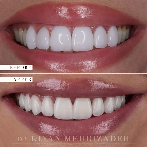 Gum lift and porcelain veneers before and after &mdash; Case Study 02