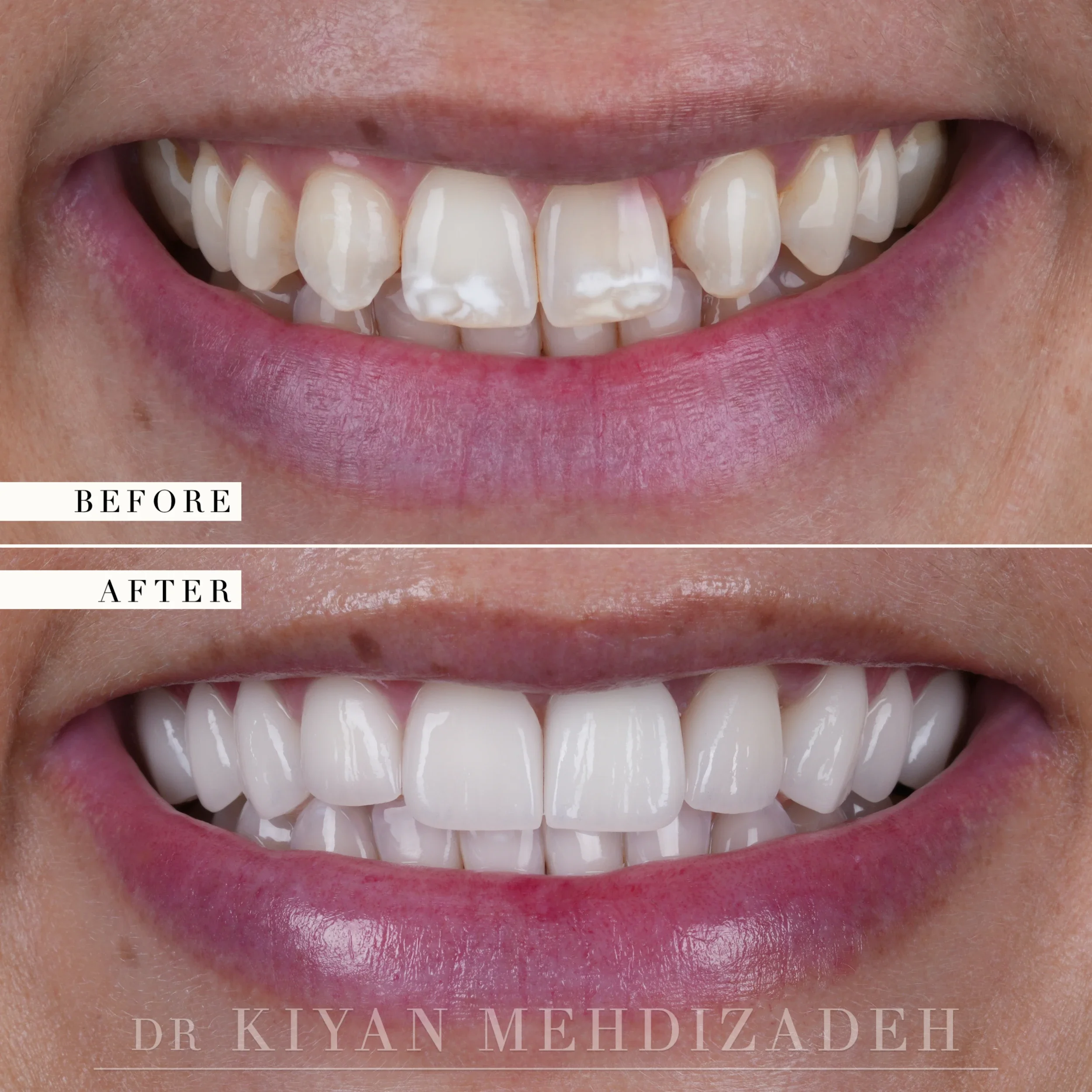 Before and after: discolored, worn upper teeth replaced with uniform restorations, Beverly Hills