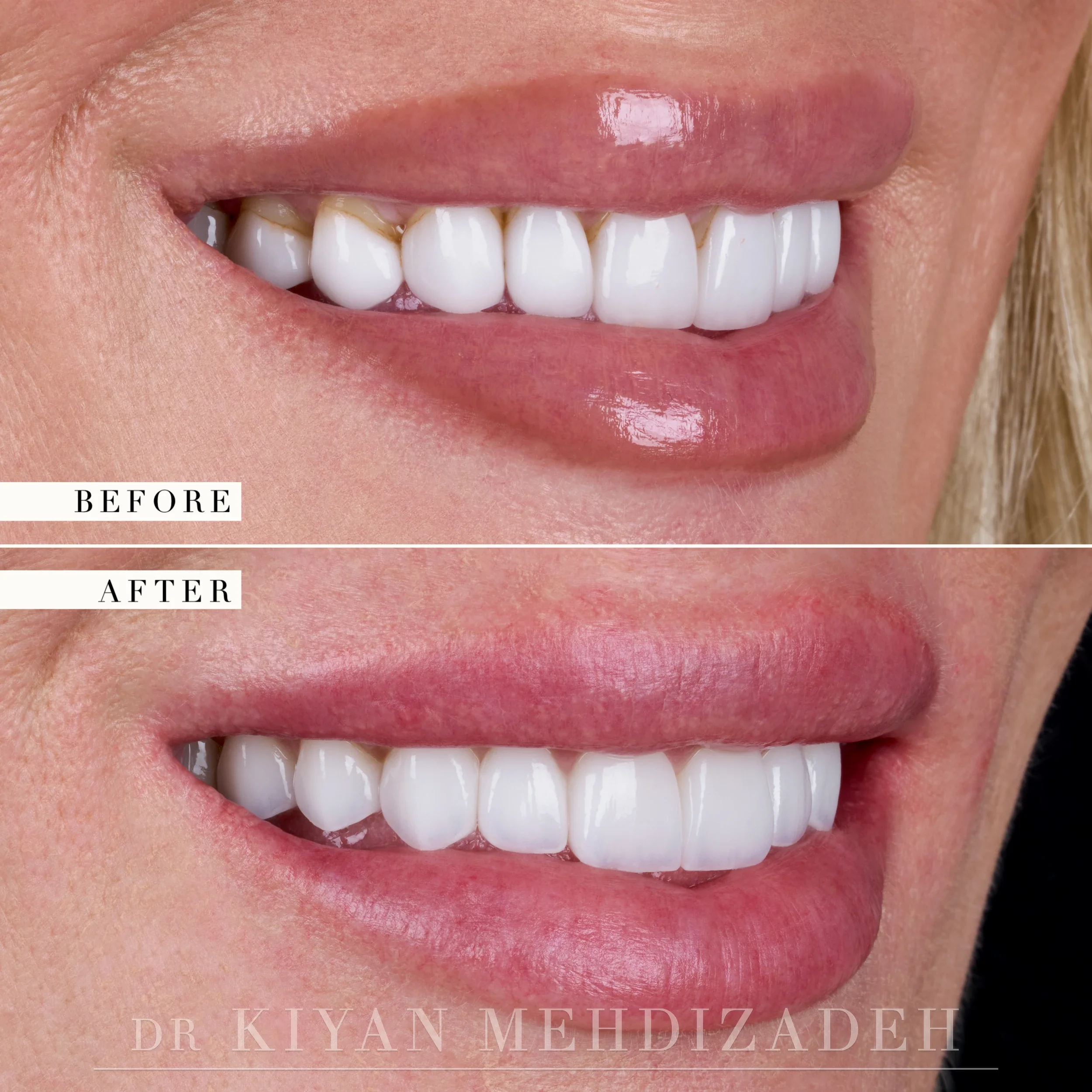 Before and after porcelain veneers and implant crowns - close-up of the smile from the right side, Beverly Hills