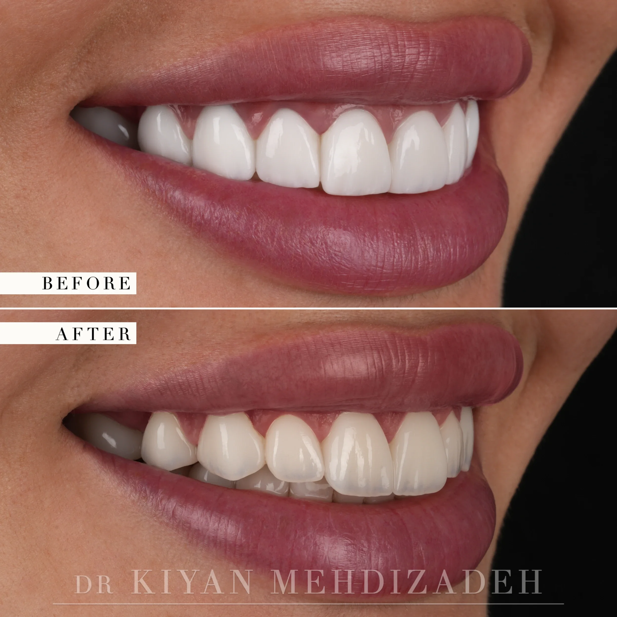 Before and after smile redesign - lateral smile angle from the right
