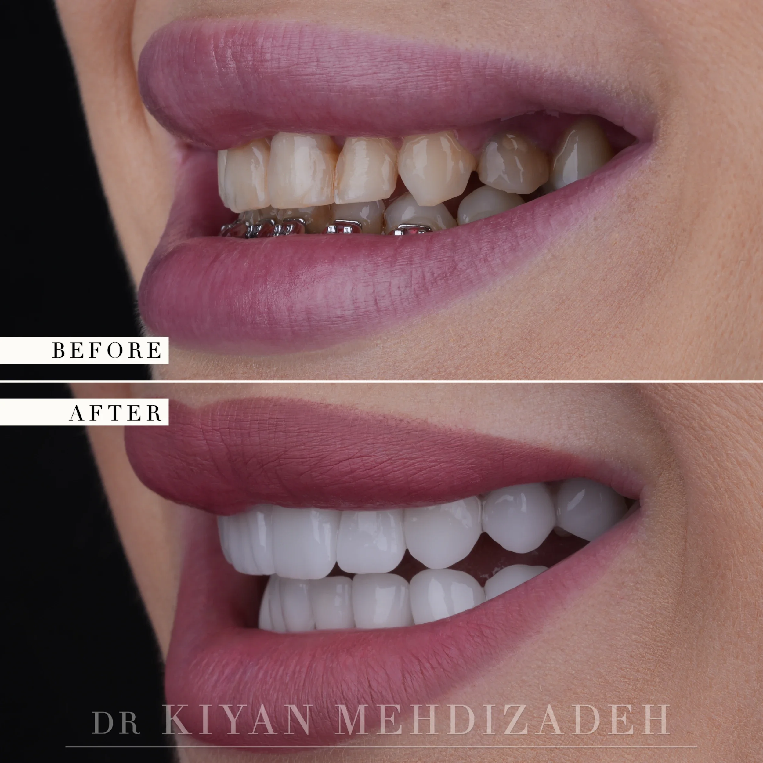 Before and after smile makeover with porcelain veneers - lateral smile angle, braces before, veneers after