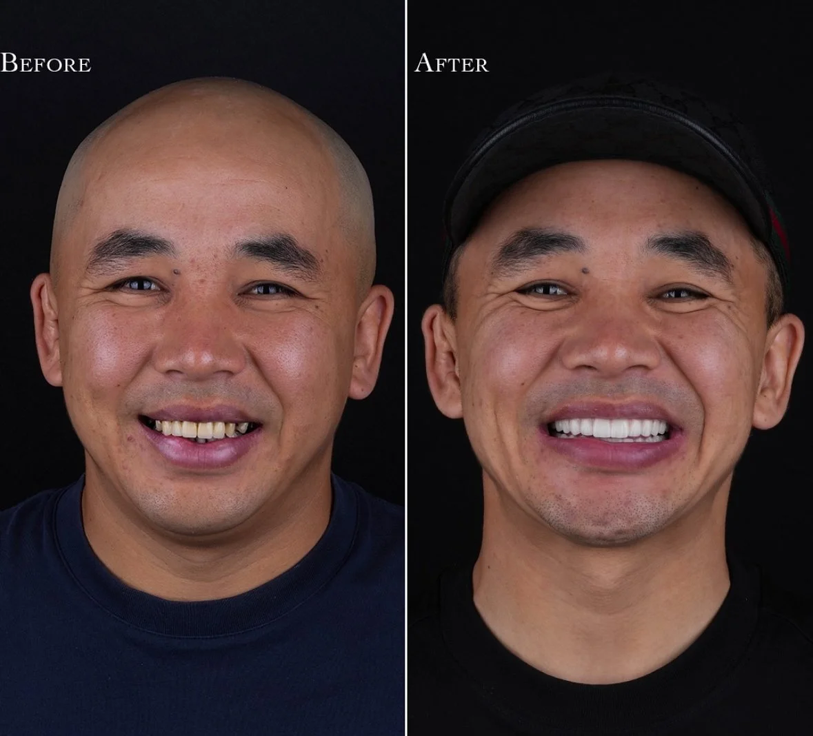 All-on-4 Implant Bridges Before and After - Full Mouth Reconstruction Beverly Hills