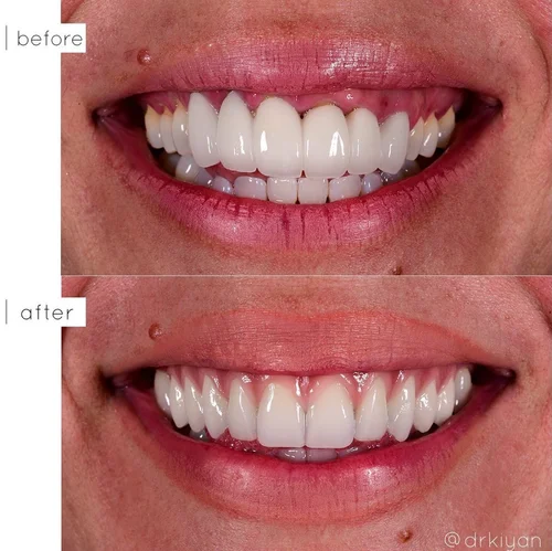All-on-4 dental implants before and after &mdash; Case Study 05