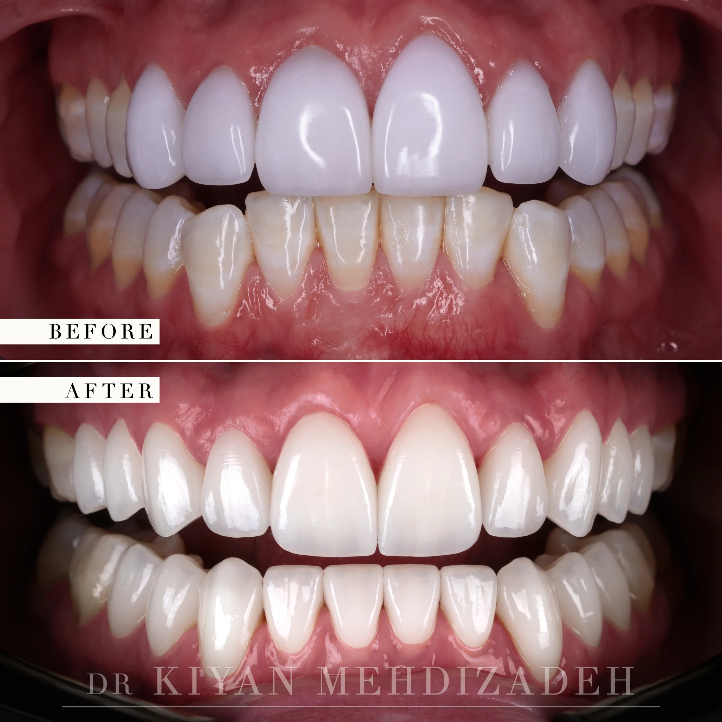 Retracted close-up before and after veneer replacement showing translucency and edge detail of the new veneers