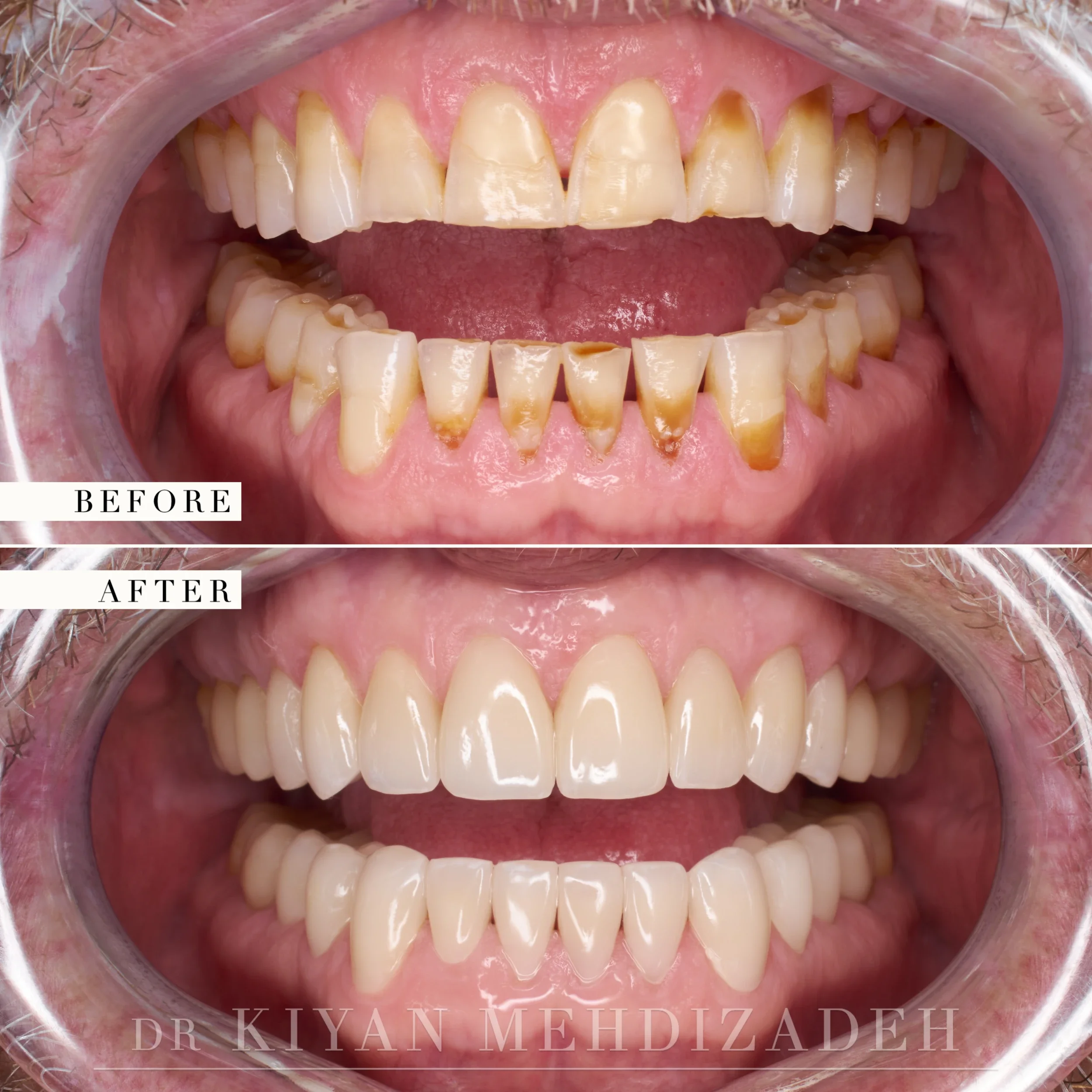 Retracted view before and after: shortened upper and lower teeth with notched edges, restored to full length across both arches, Beverly Hills