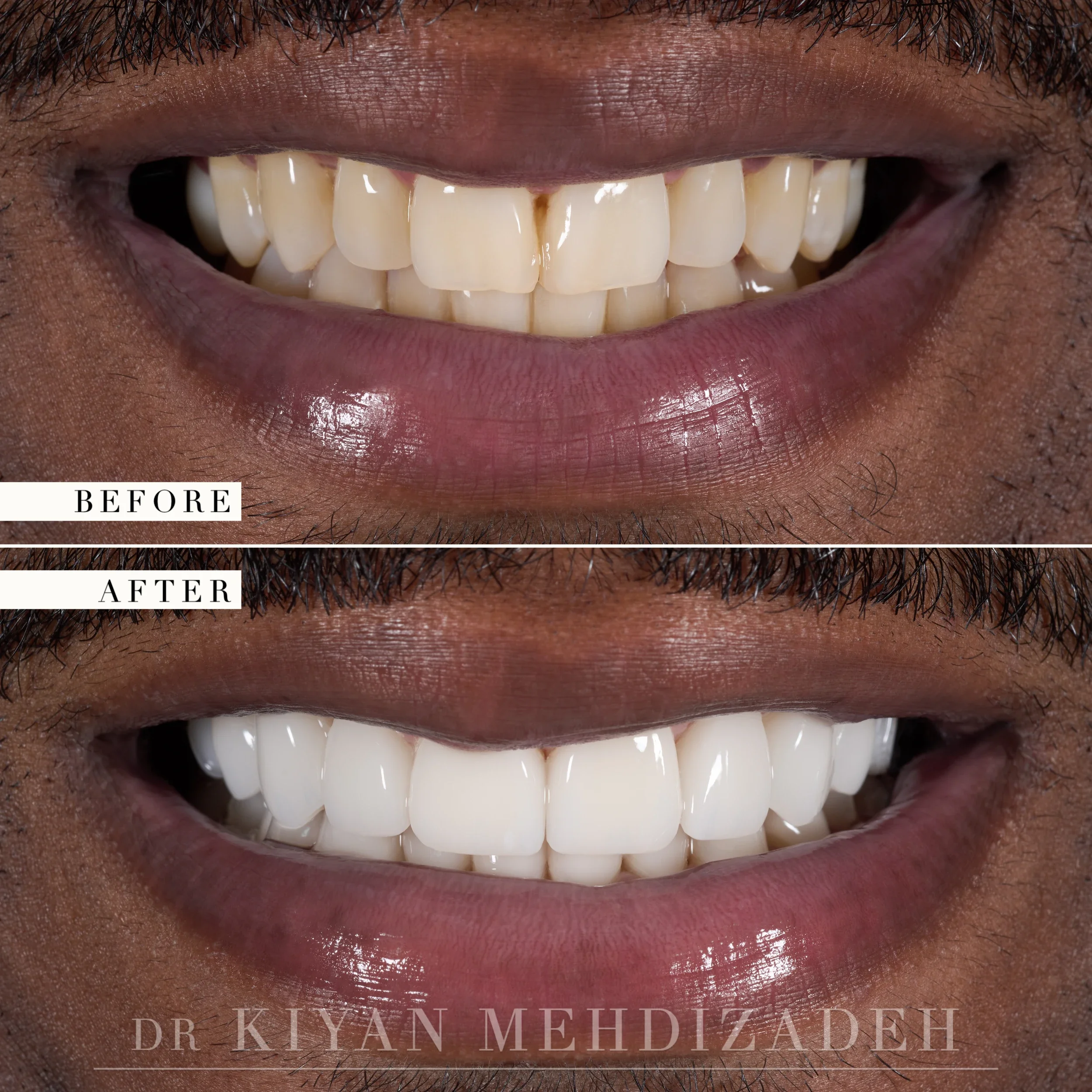 Before and after: discolored upper and lower teeth with uneven proportions and dark spaces, restored with three implant crowns and seventeen porcelain veneers, Beverly Hills