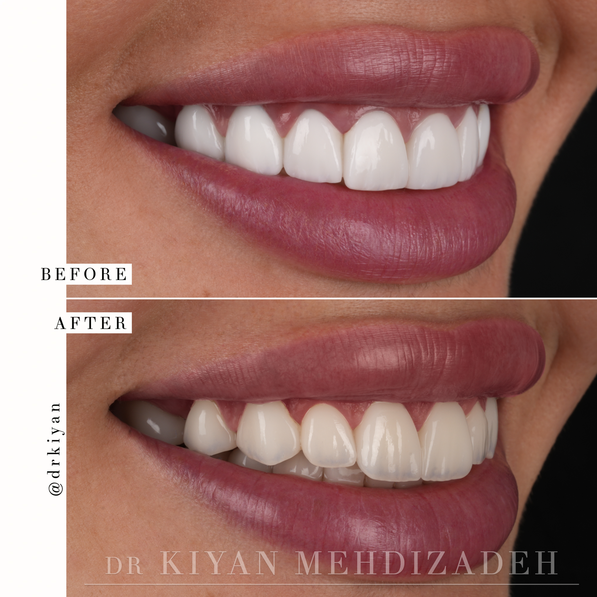 Smile Makeover with Gum Lift and Veneers - Dr. Kiyan Beverly Hills
