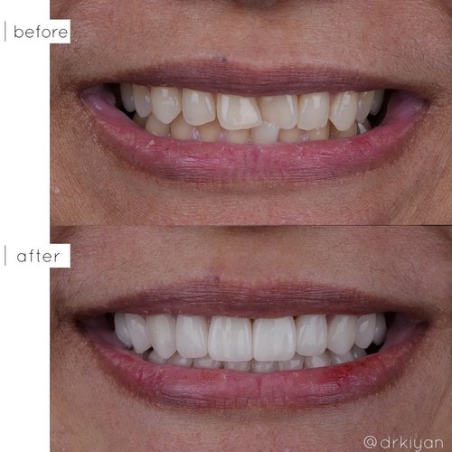 Crossbite correction without braces before and after &mdash; Case Study 08