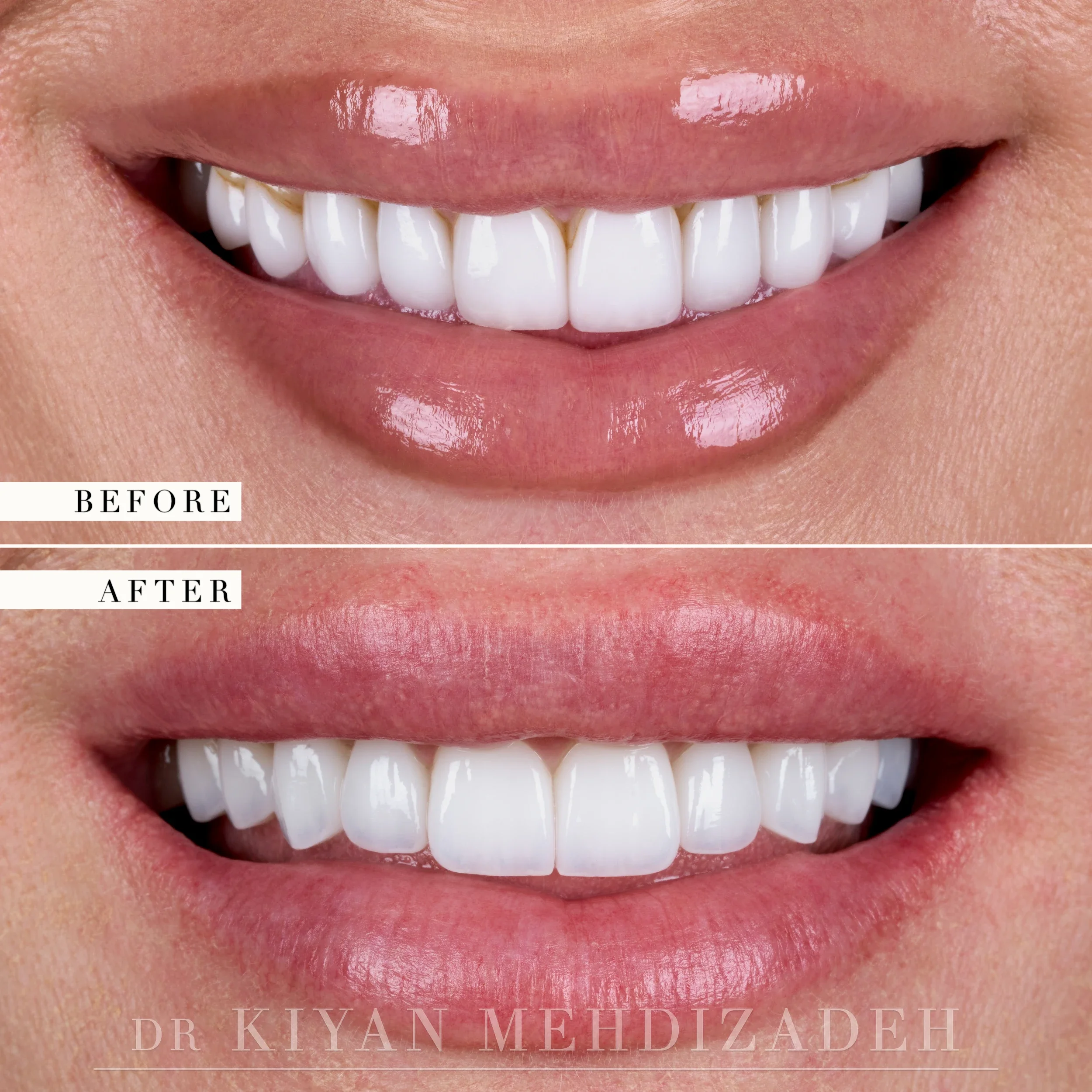 Before and after porcelain veneers and implant crowns - close-up of the smile with the lips framing the teeth, Beverly Hills