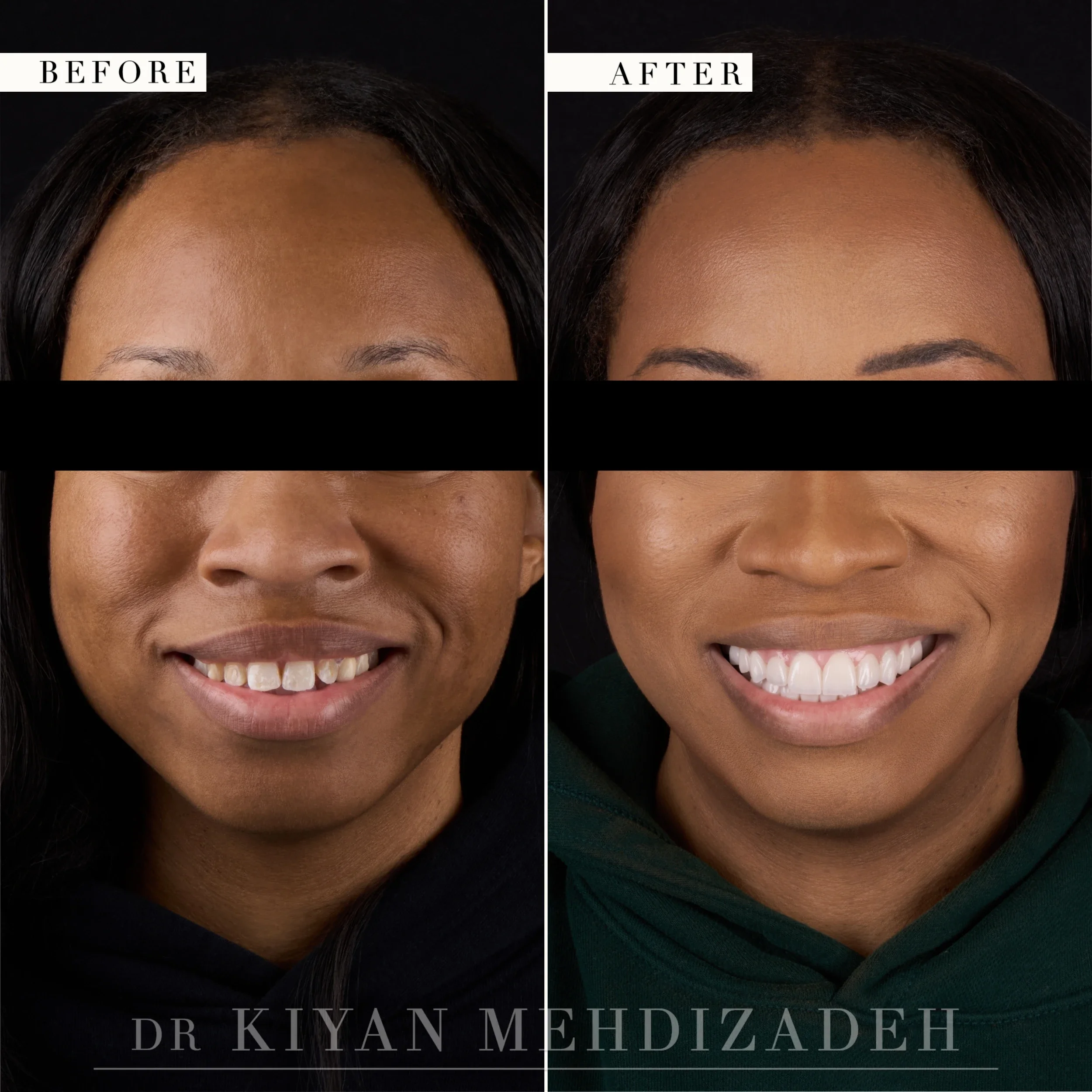 Full-face front view after veneers corrected flaring and discoloration