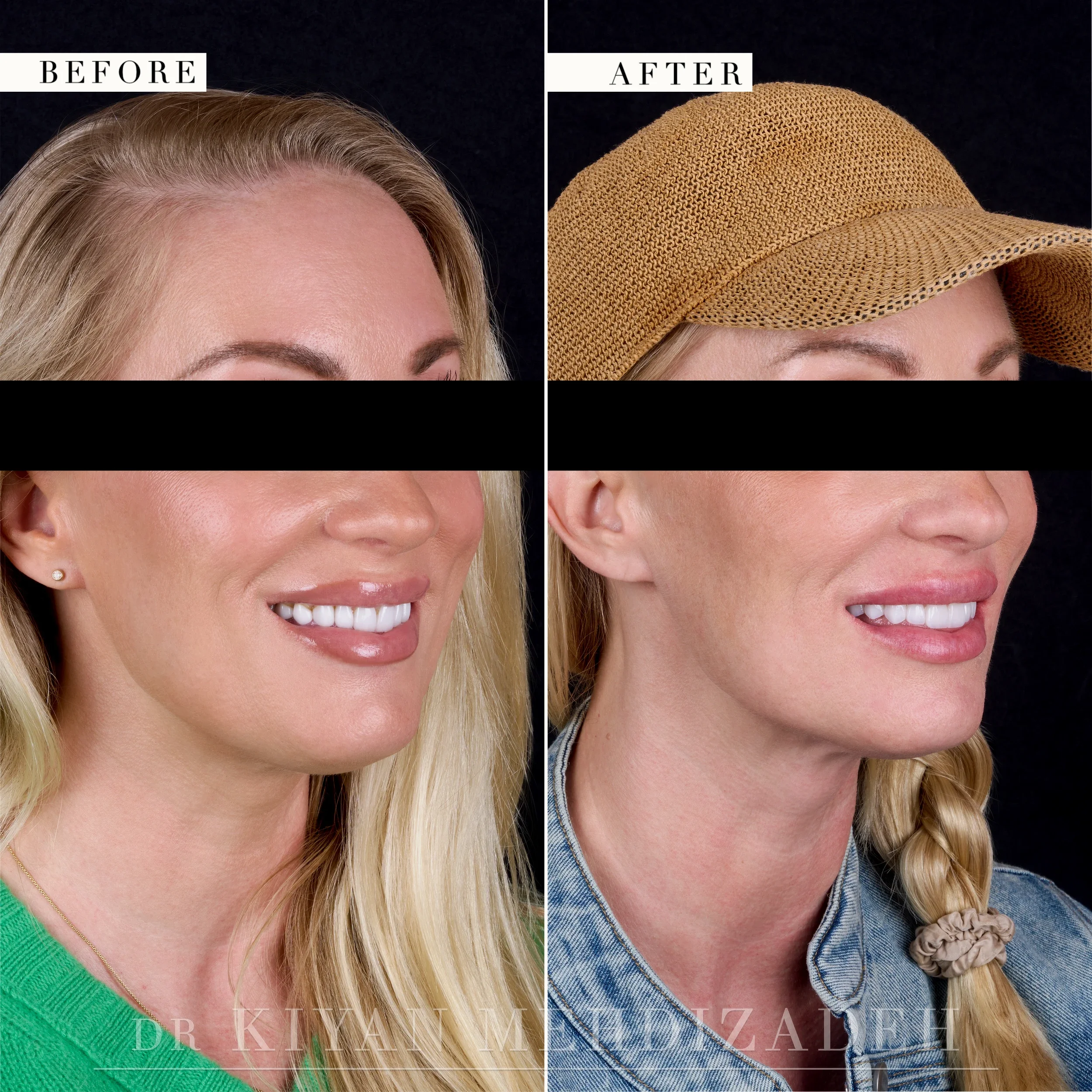Before and after full-face portrait with the face turned to the right, eyes redacted - porcelain veneers and implant crowns, Beverly Hills