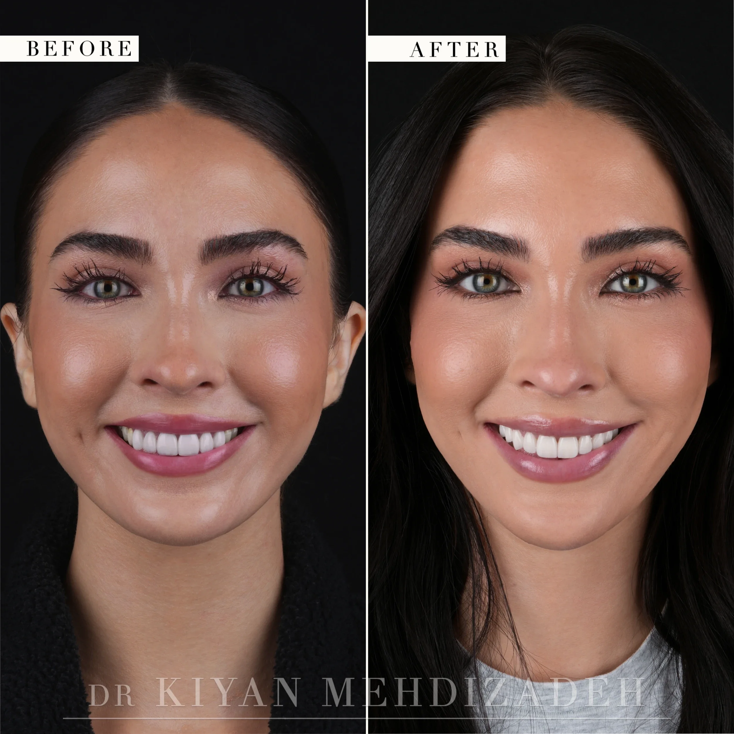 Full-face frontal portraits before and after porcelain veneer replacement