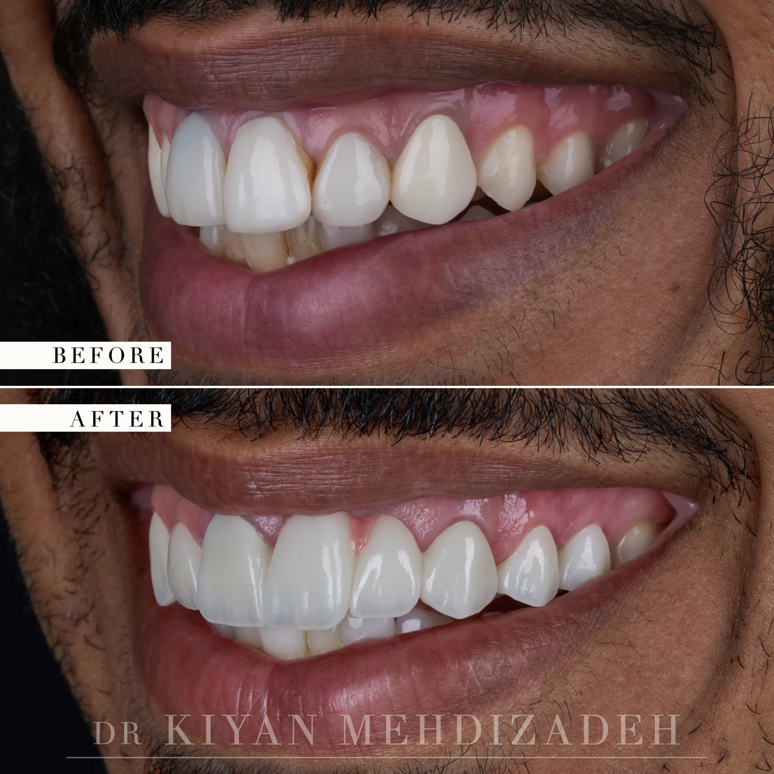 Lateral view after a pink porcelain bridge and veneers