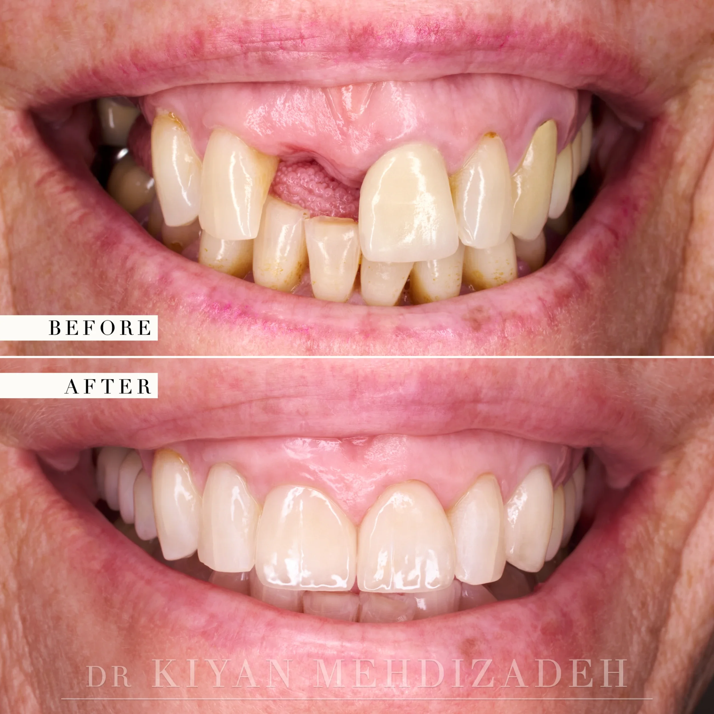 Before and after: three missing teeth and a mismatched crown replaced with implant crowns shade-matched to the natural dentition, Beverly Hills