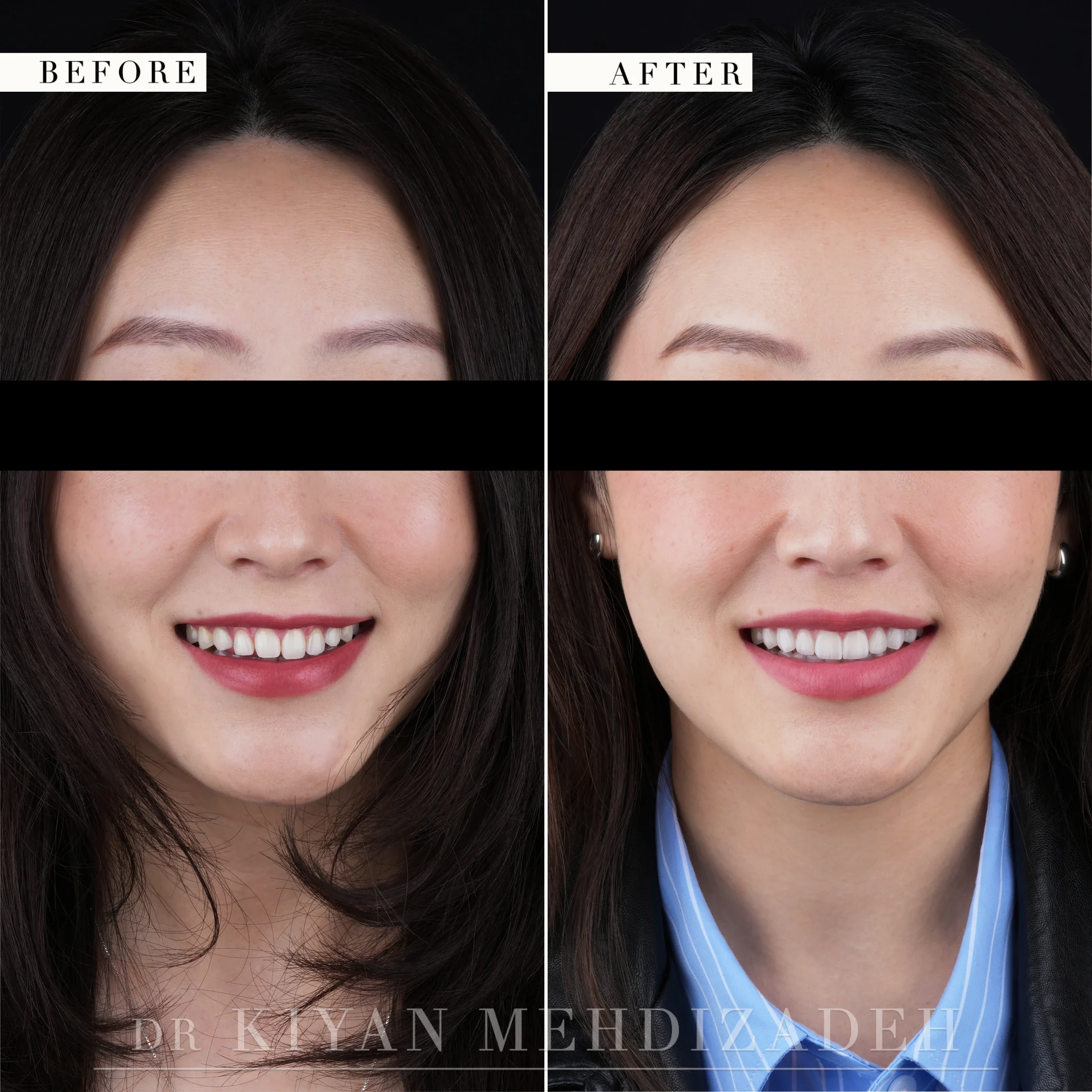 Before and after treatment for congenitally missing canines with gum lift and porcelain veneers - full-face portrait