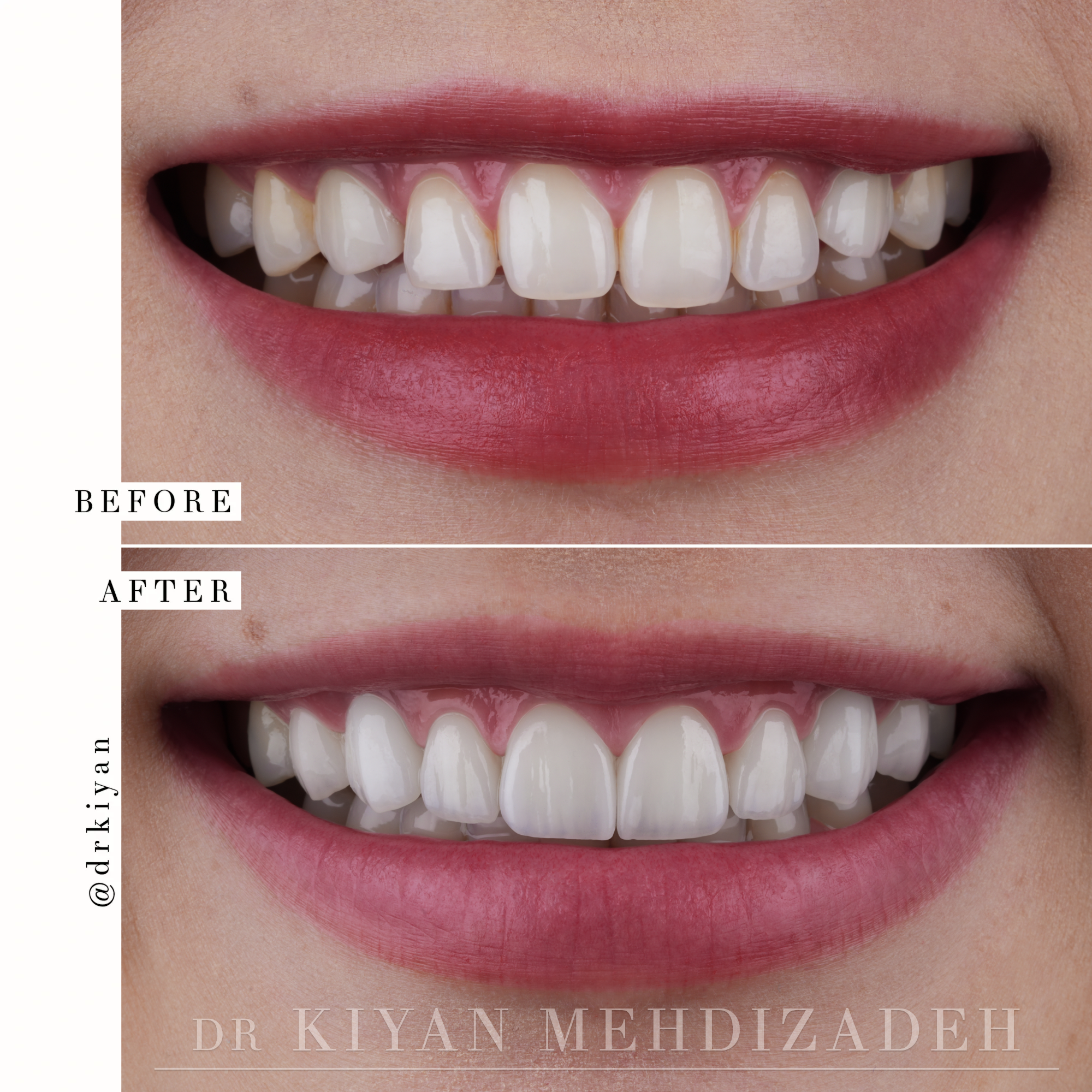 Close-Up Smile After Gum Lift and Veneers - Dr. Kiyan Mehdizadeh