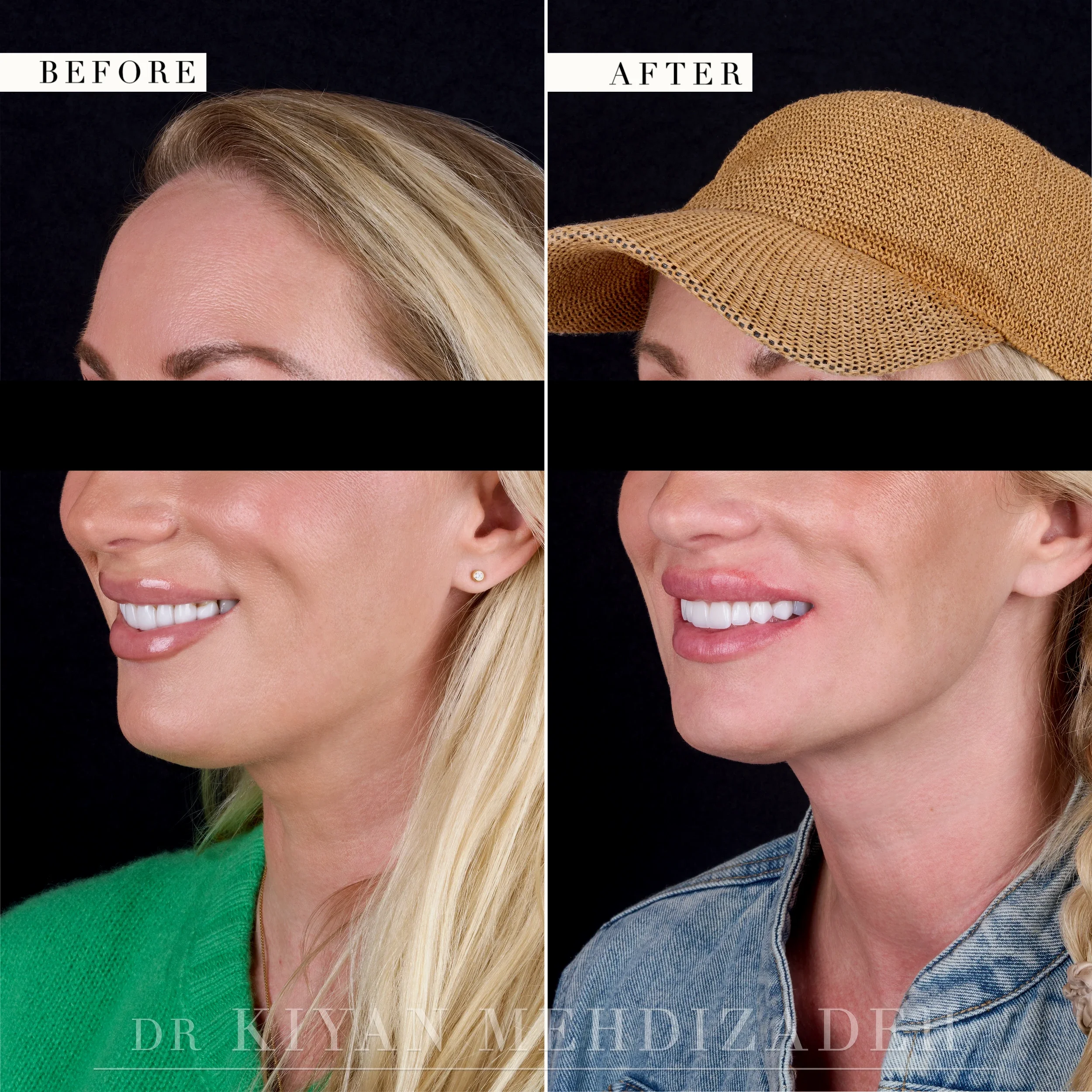 Before and after full-face portrait with the face turned to the left, eyes redacted - porcelain veneers and implant crowns, Beverly Hills