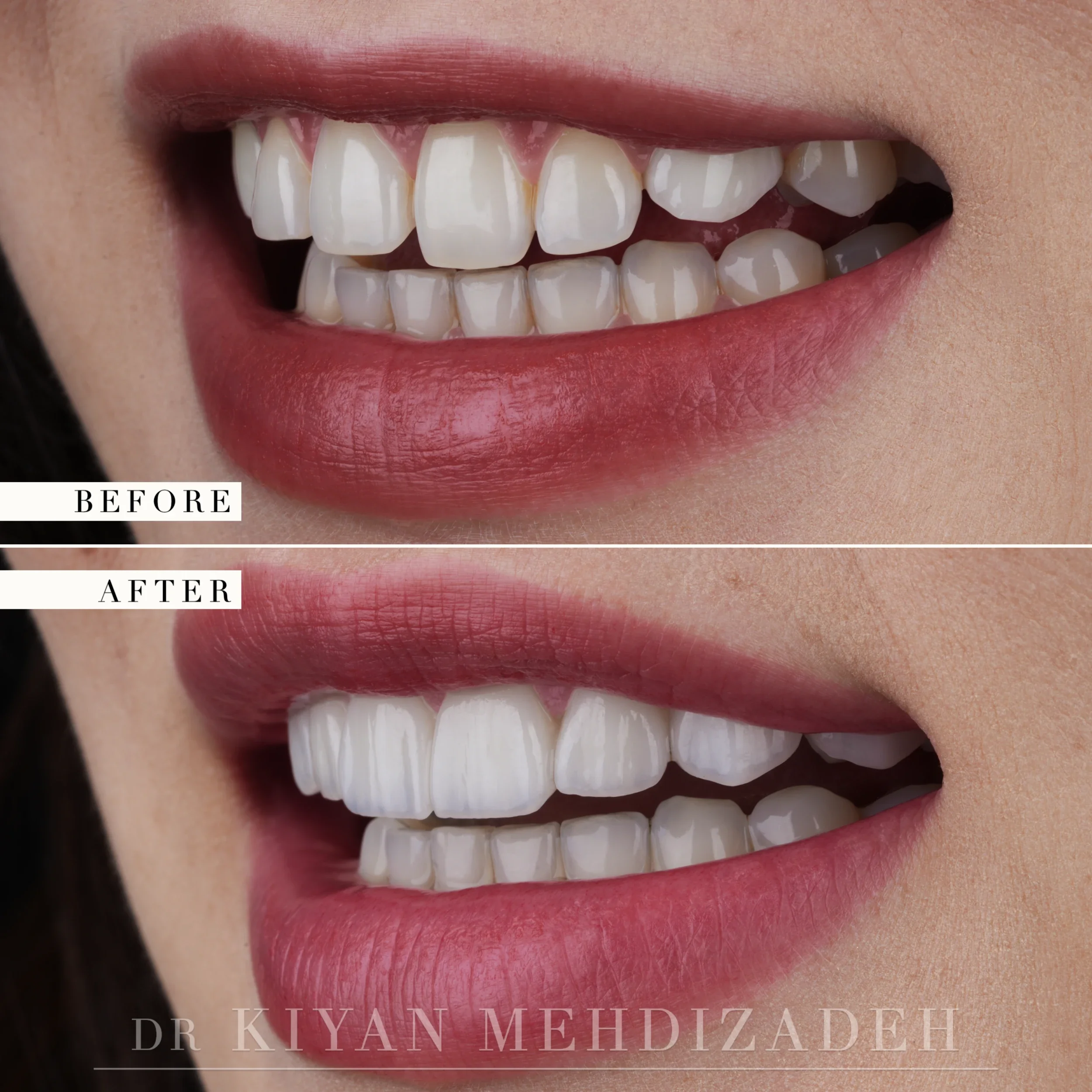 Before and after gum lift and porcelain veneers harmonising existing dental implants - smile view