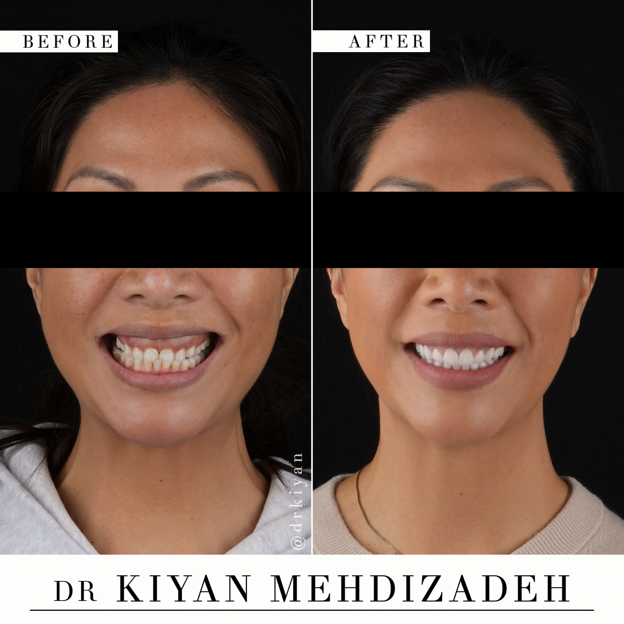 Frontal View After Gum Lift and Veneers - Dr. Kiyan Mehdizadeh Beverly Hills