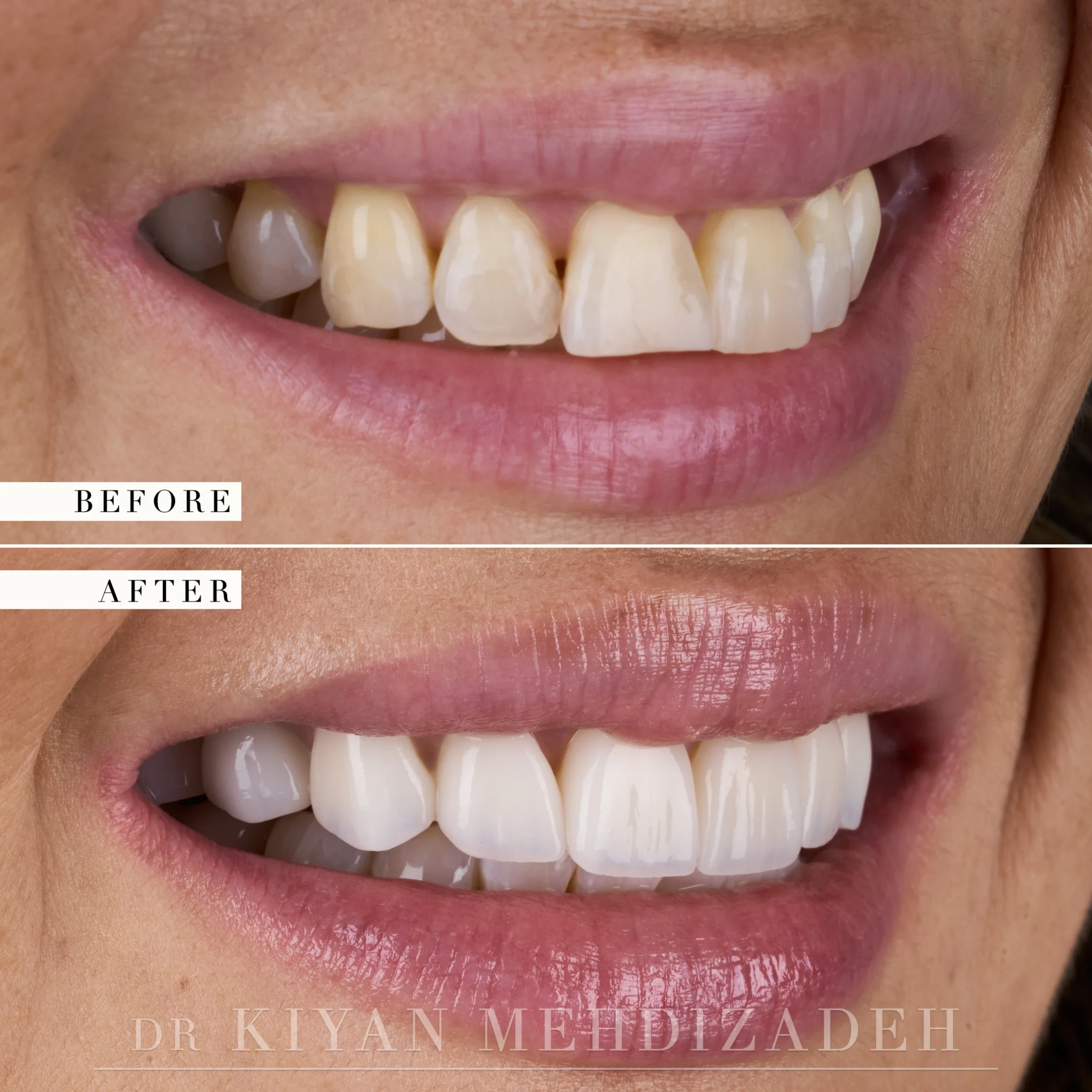 Left lateral view after veneers replaced old bonding