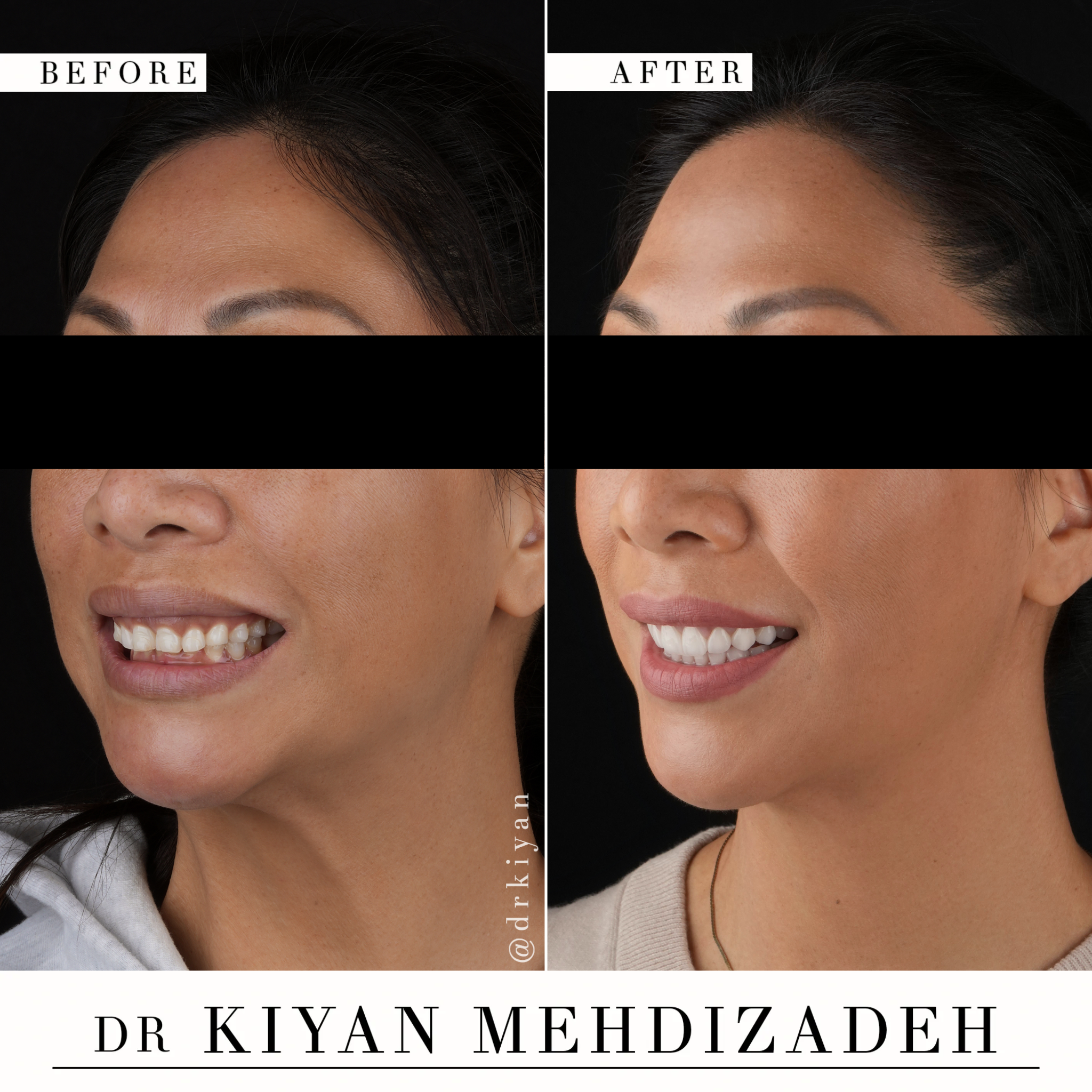 Side View After Gum Lift and Veneers - Dr. Kiyan Mehdizadeh Beverly Hills