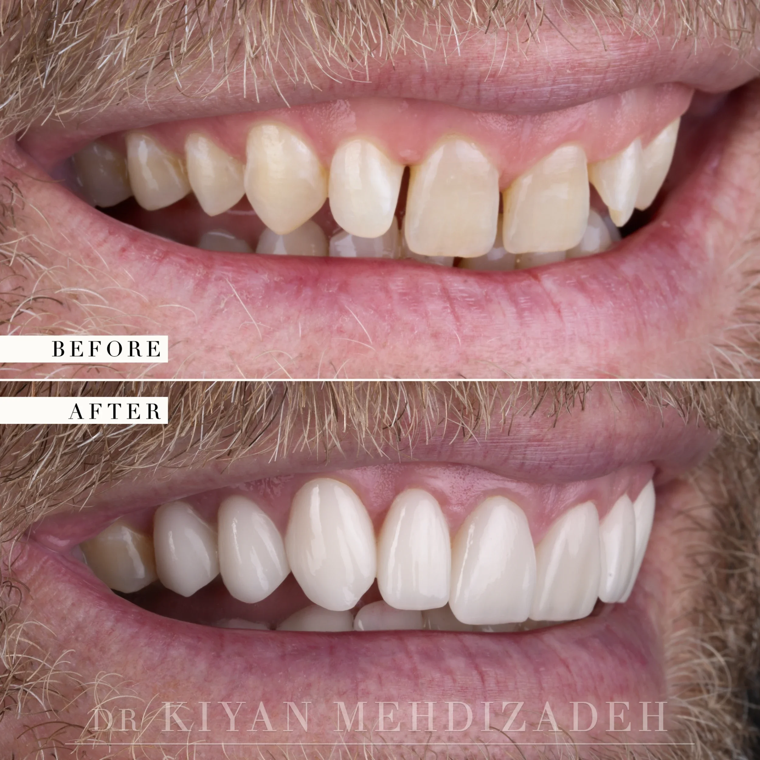 Right lateral view of the smile, before and after
