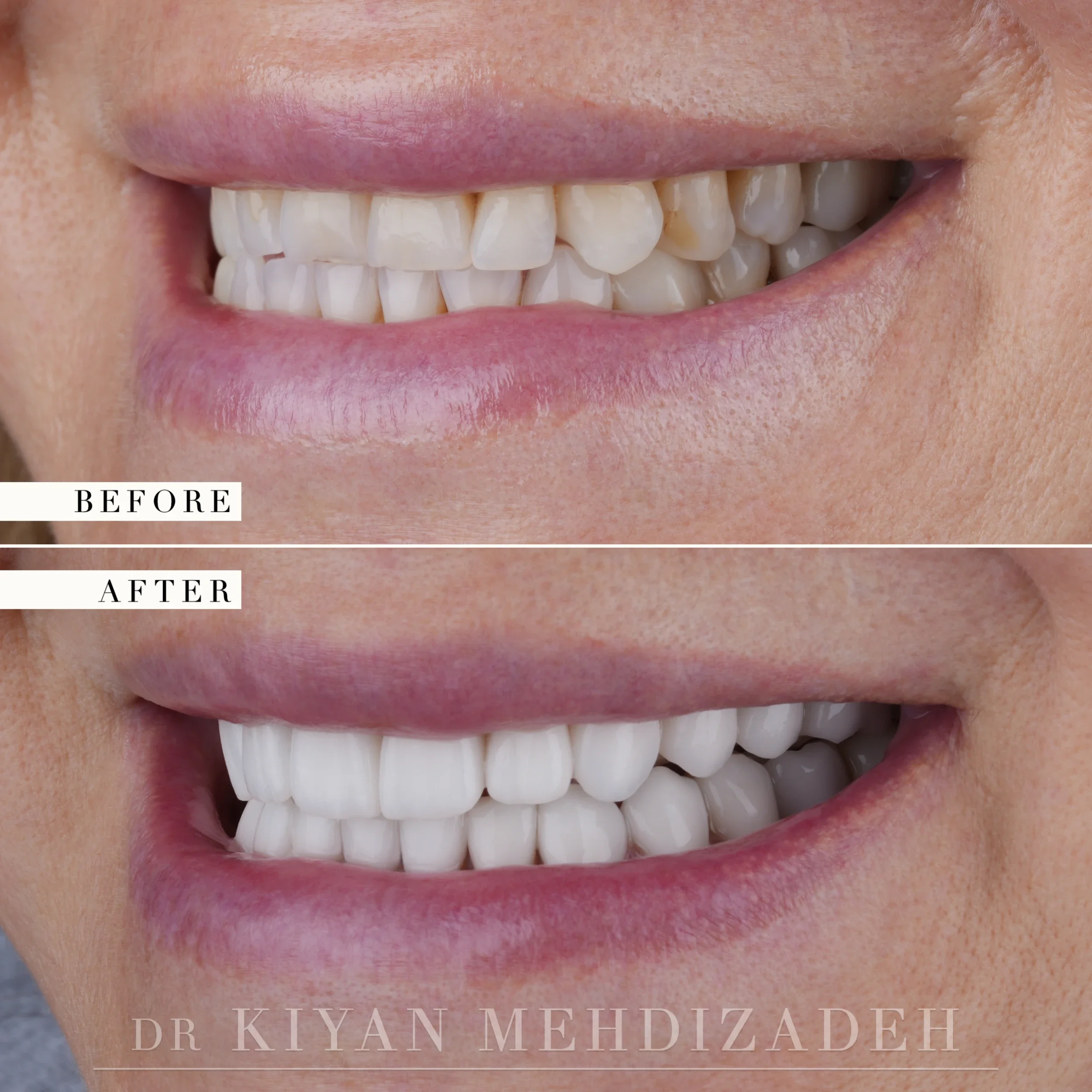 Left side before and after: flattened incisal edges and yellowed posterior teeth restored to full length in uniform porcelain, Beverly Hills