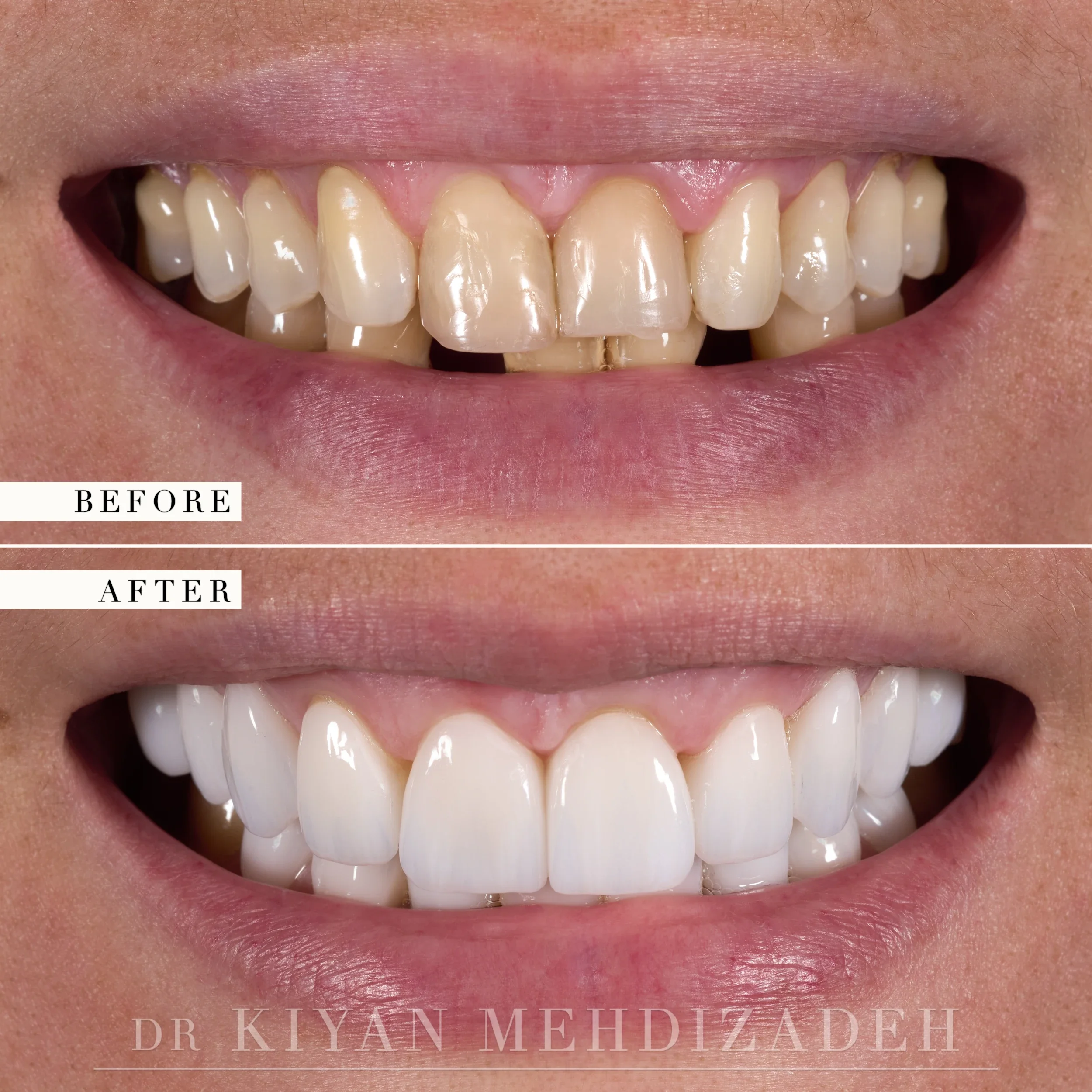 Before and after: discoloured, unevenly sized teeth and two missing lower teeth restored with implants and eighteen ceramic restorations, Beverly Hills