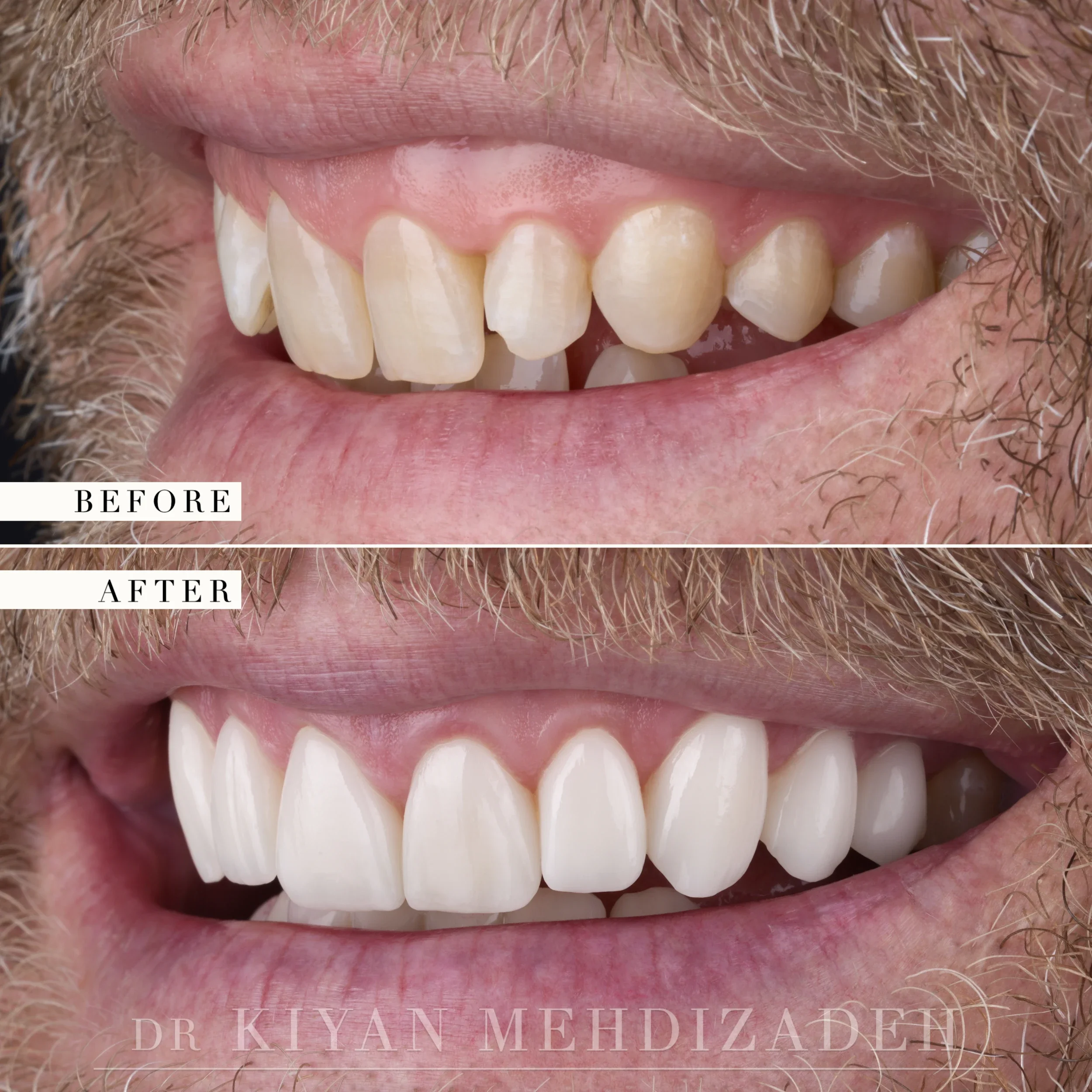 Lateral view of the smile, before and after