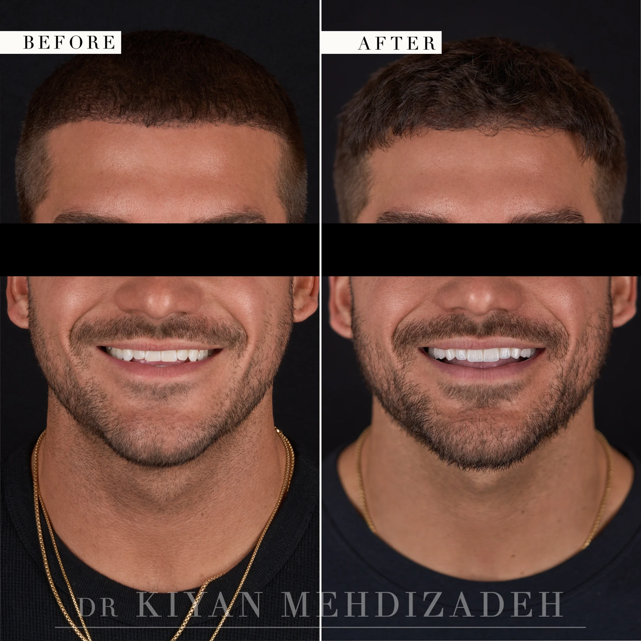 Chipped teeth restored with masculine veneers, before and after, Beverly Hills