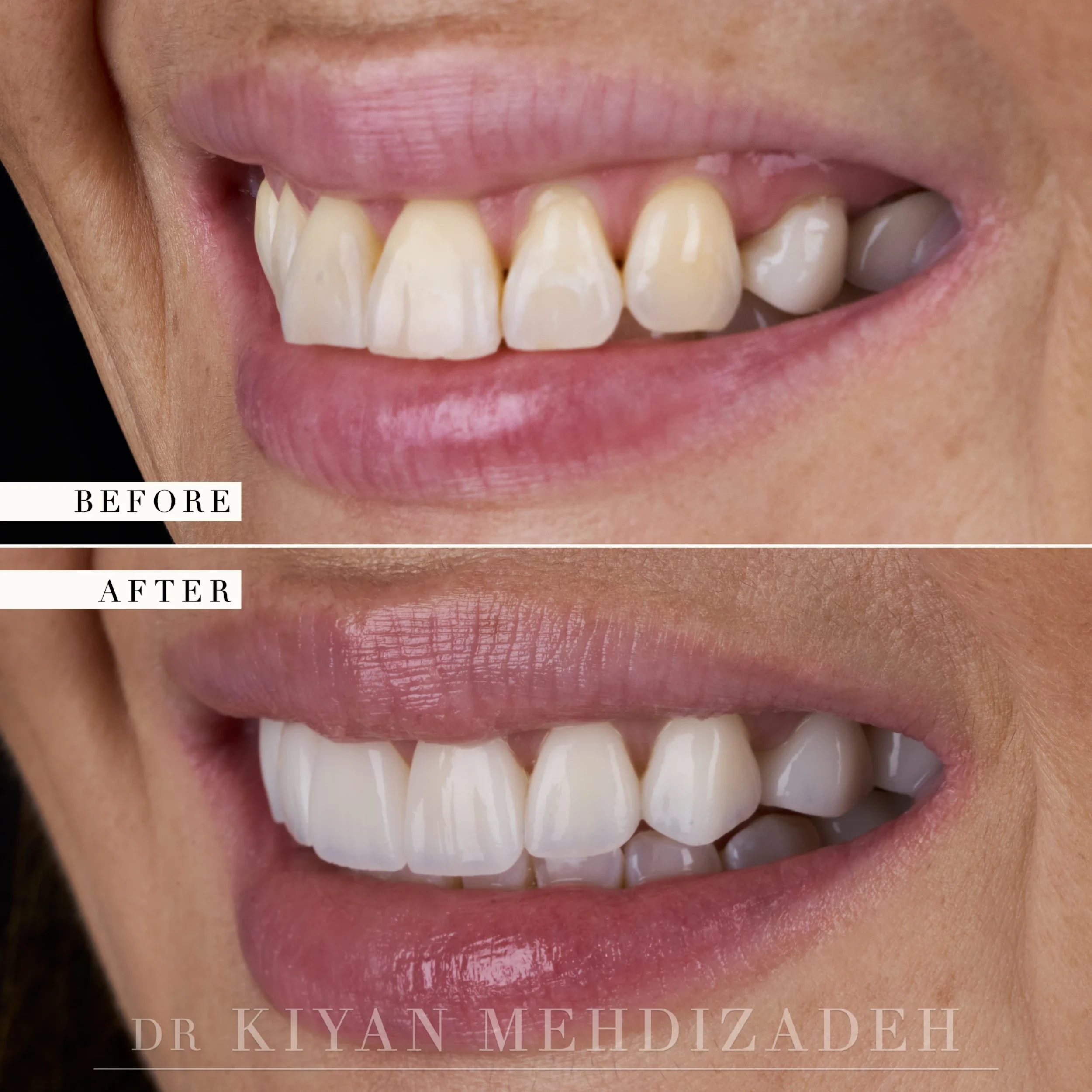 Right lateral view after veneers replaced old bonding