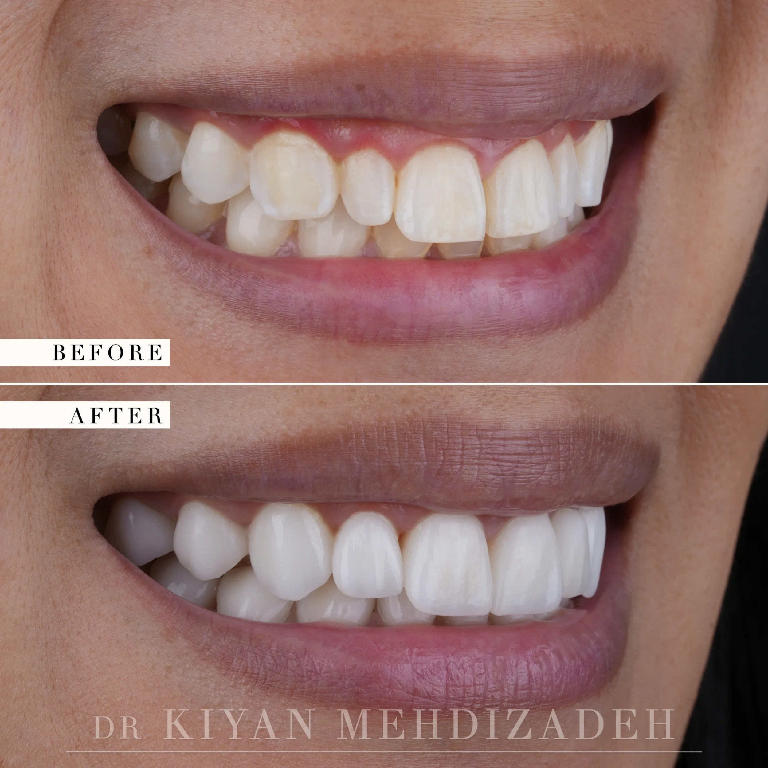 Right side before and after: crowded, discolored upper teeth with heavy gum display, restored to an aligned veneered arch, Beverly Hills