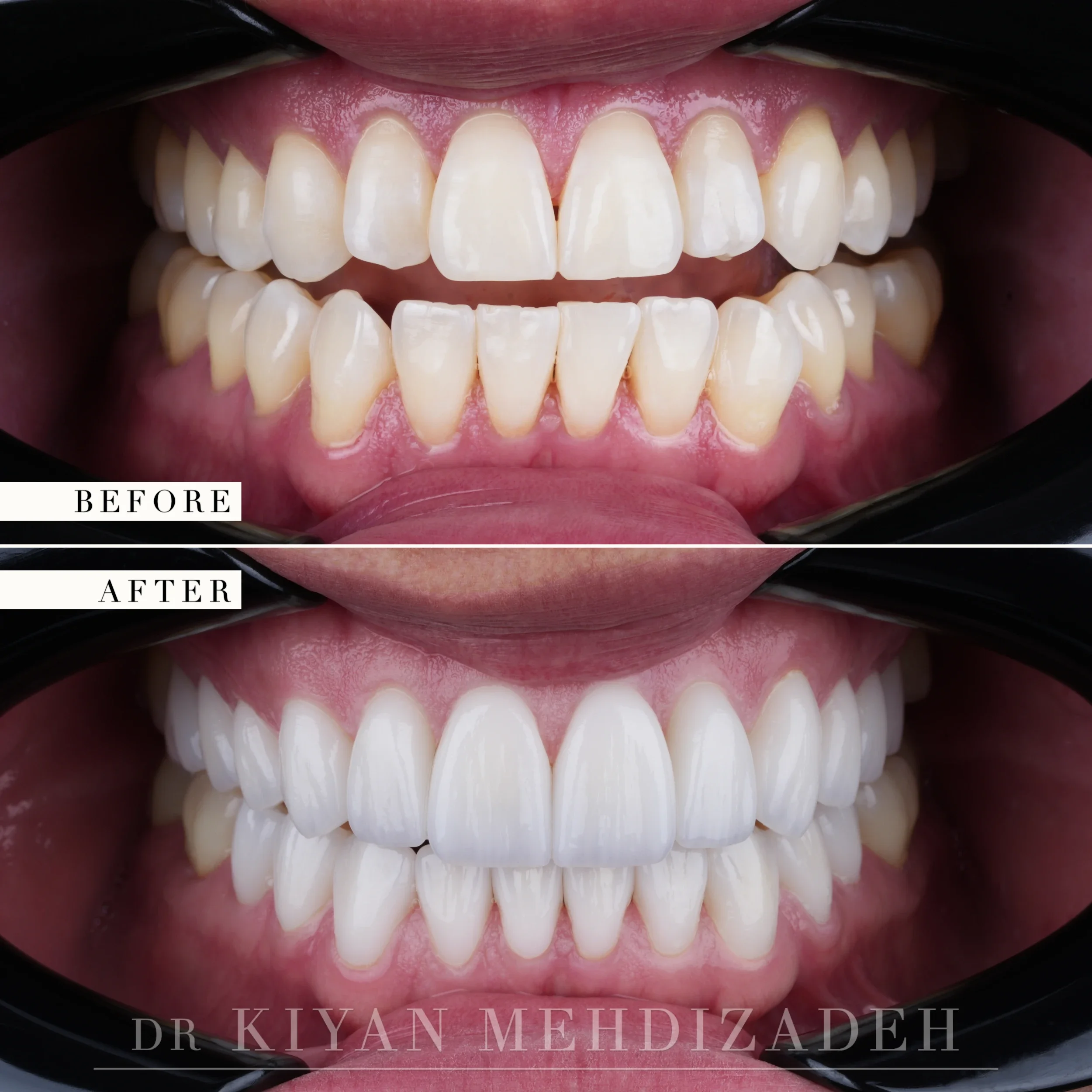 Before and after full mouth porcelain veneers - retracted view showing surface texture