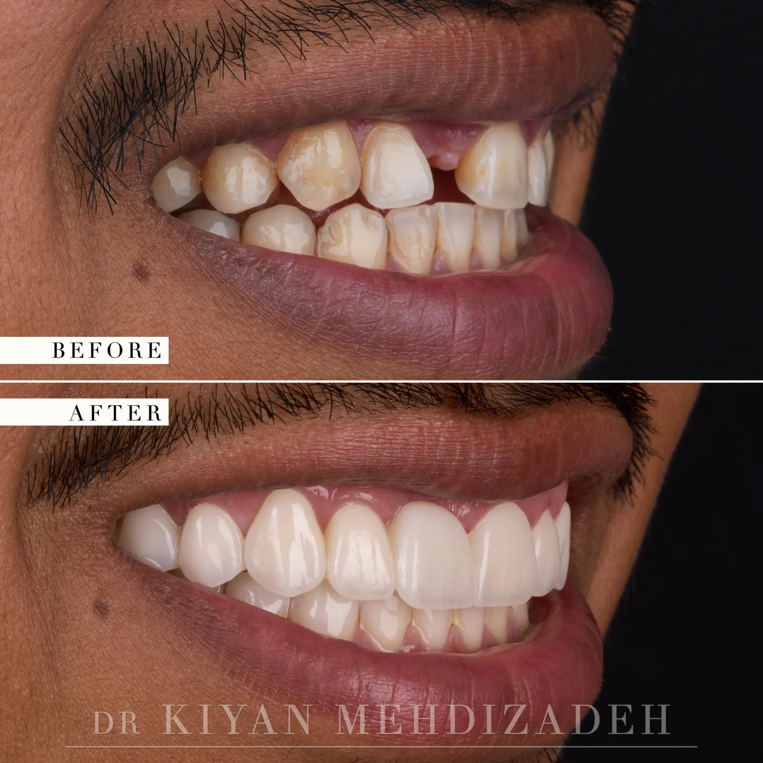 Left lateral view after a three-unit bridge and porcelain veneers