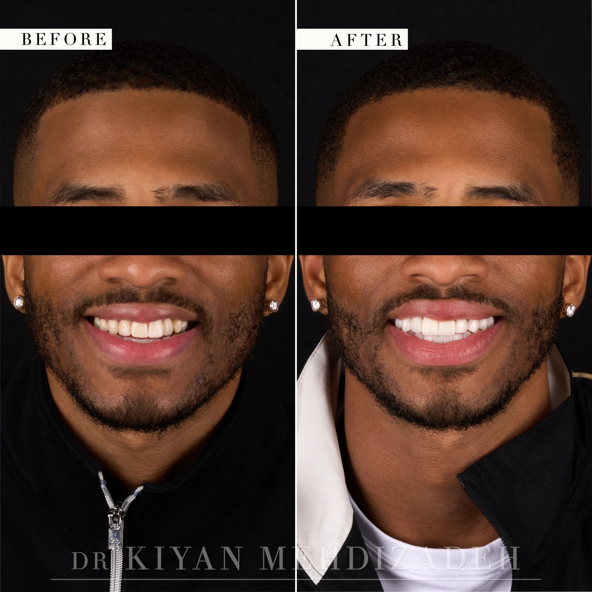 Full-face front view after full-mouth veneers corrected an underbite