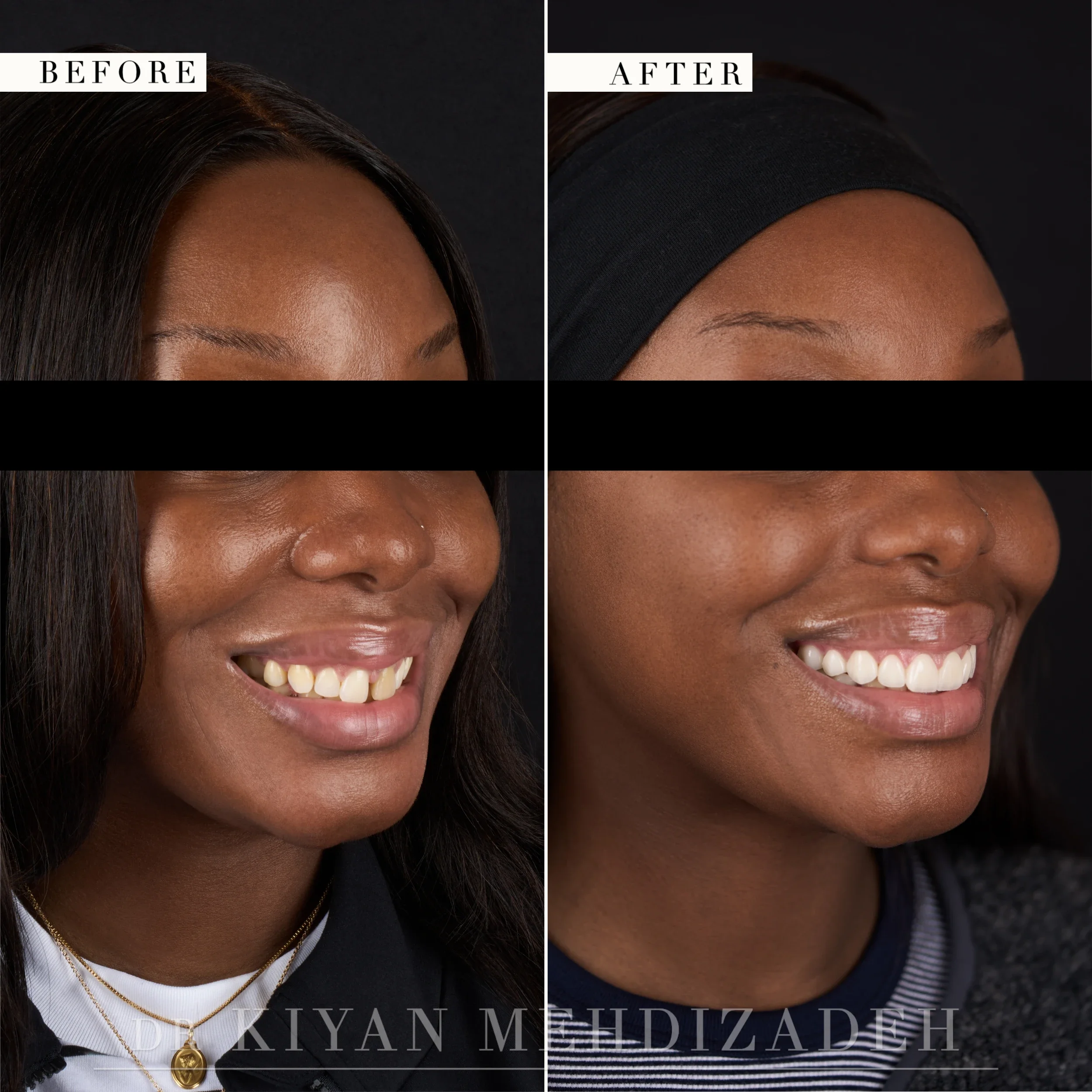 Three-quarter right view after gap-closure veneers
