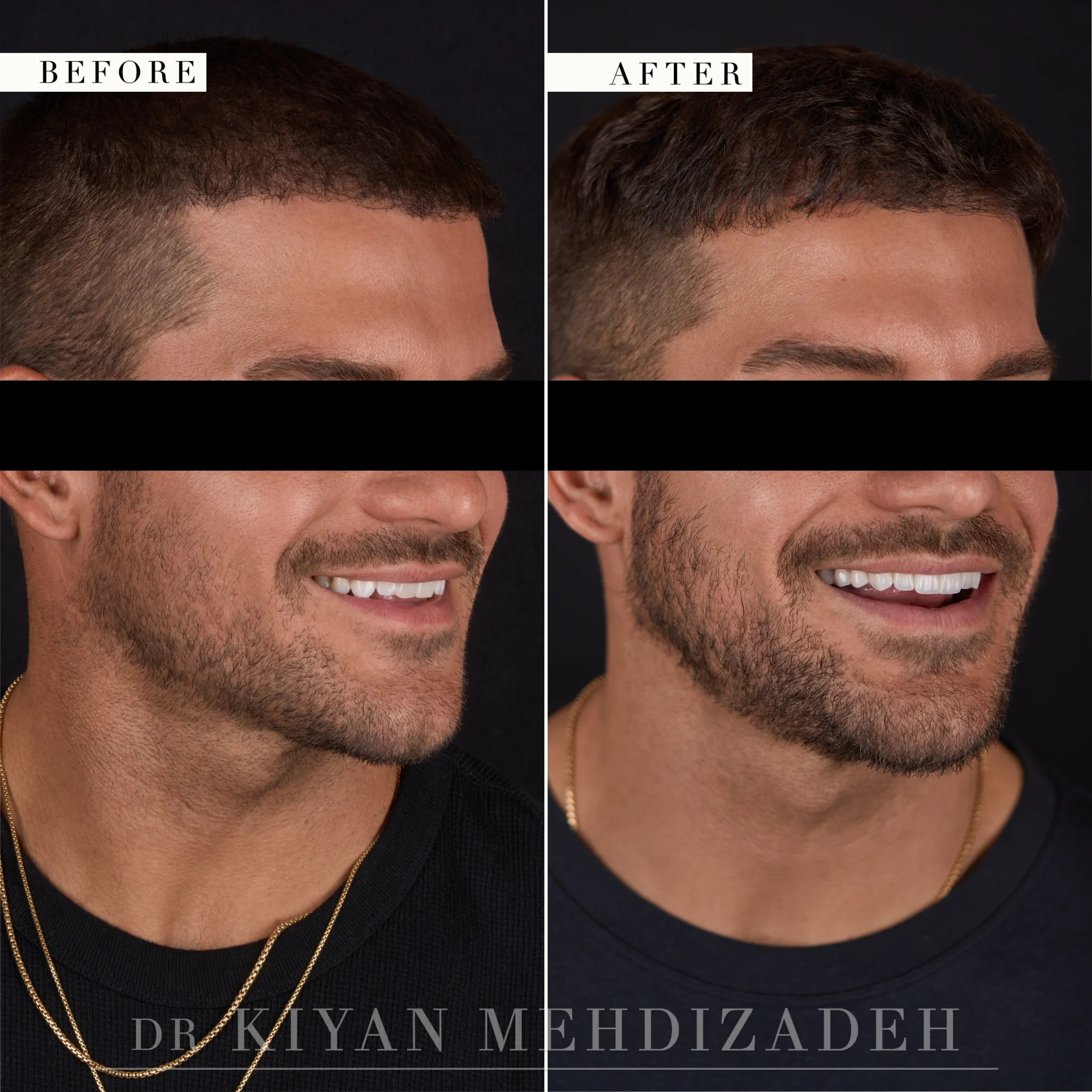 Three-quarter view after masculine veneers restored a chipped smile