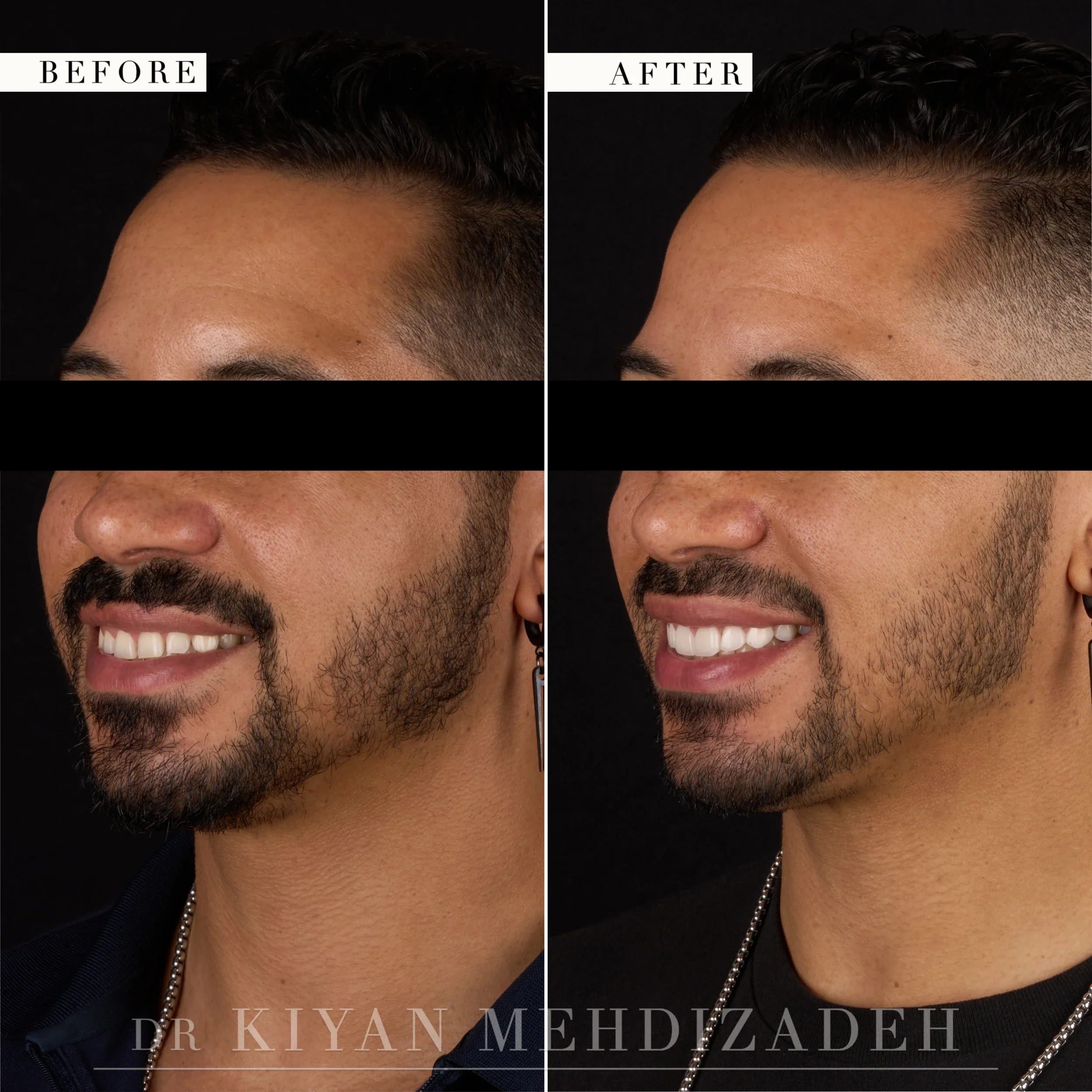 Three-quarter right view after crown lengthening and veneers