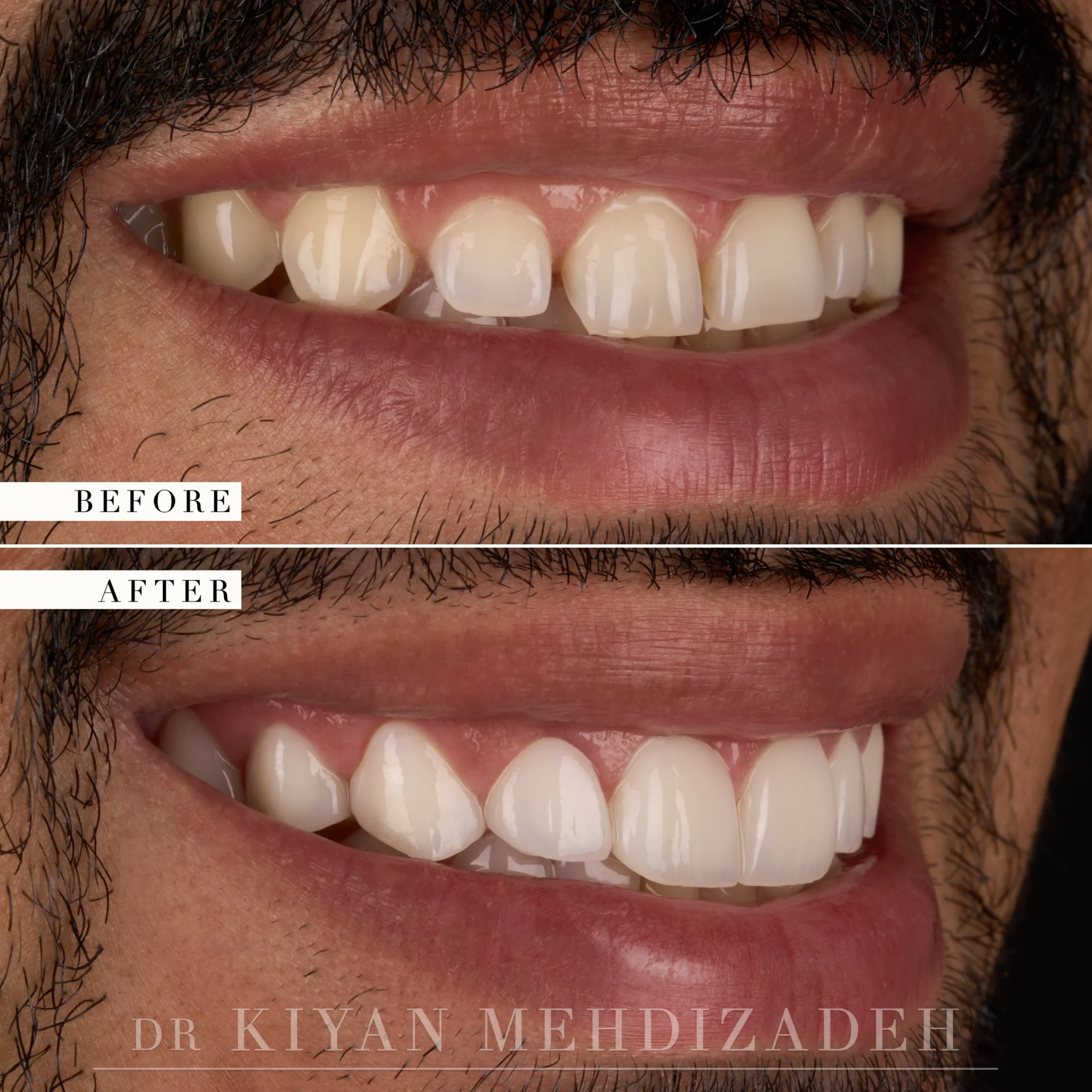 Left lateral view after crown lengthening and veneers