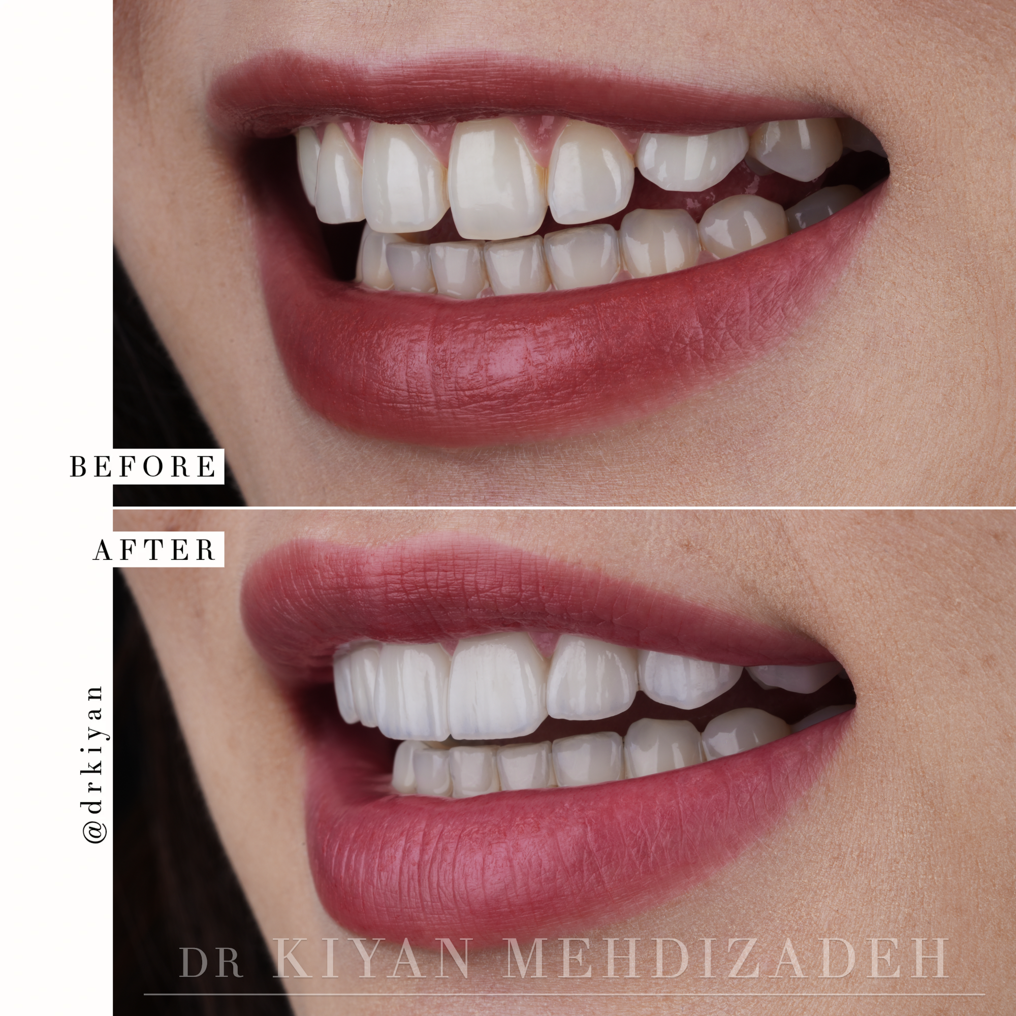 Smile Transformation with Gum Lift and Veneers - Beverly Hills