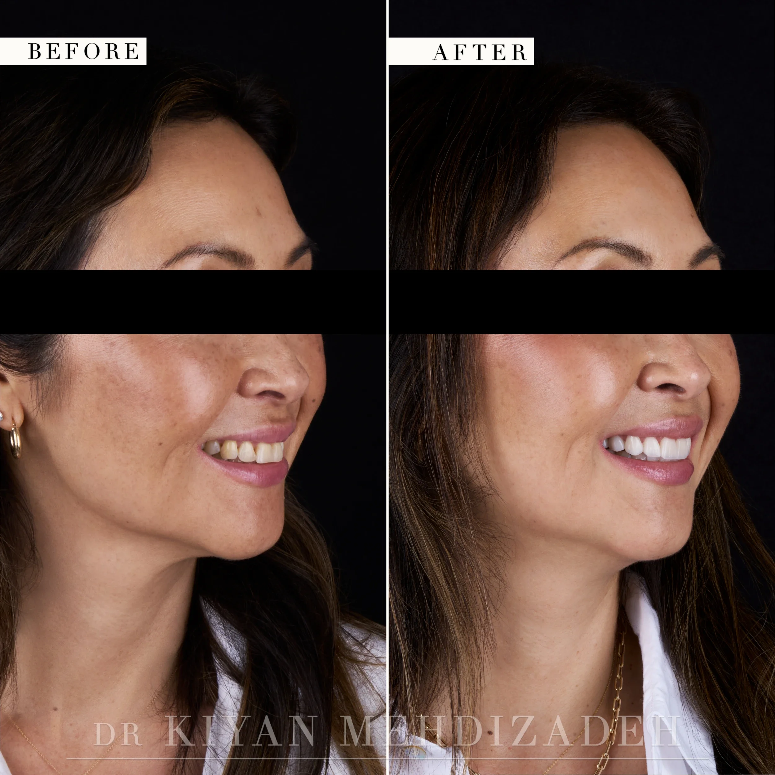 Three-quarter left view after veneers replaced old bonding