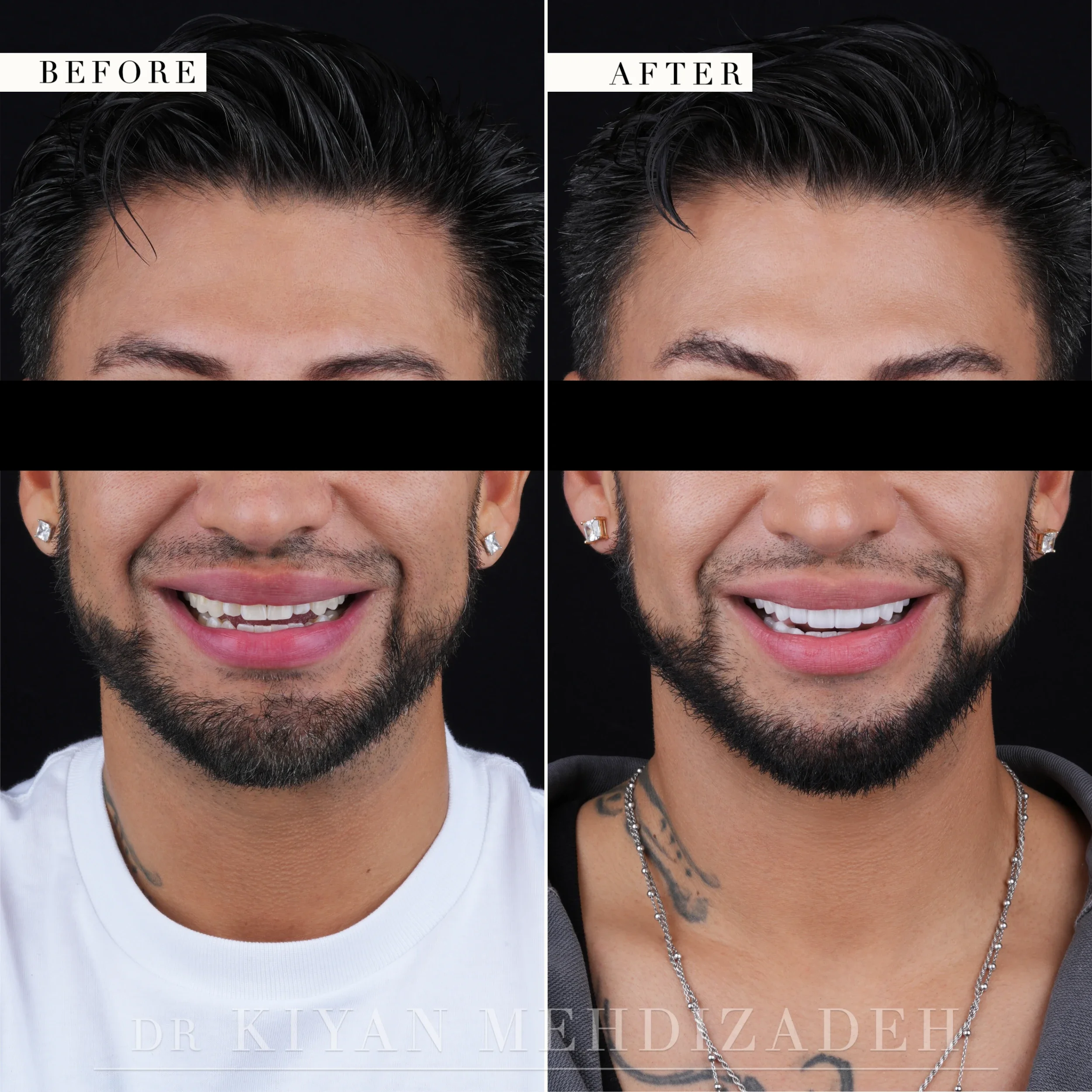 Before and after full mouth porcelain veneers - full-face portrait